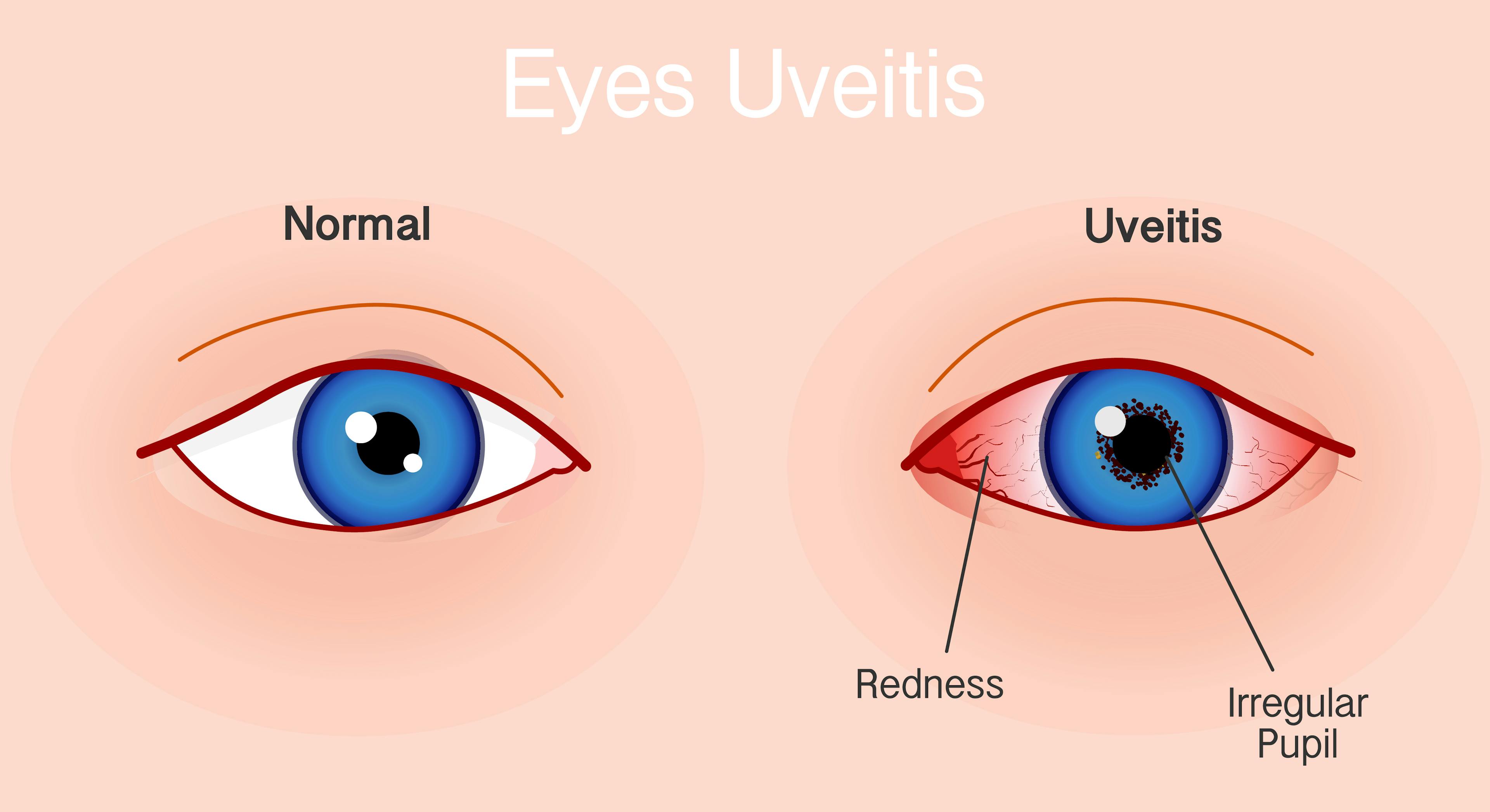 Illustration comparing a normal eye to an eye with uveitis. The normal eye appears clear with a regular, round pupil and no redness. The eye with uveitis shows visible redness, bloodshot appearance, and an irregularly shaped pupil, labeled with arrows pointing to 'Redness' and 'Irregular Pupil'.