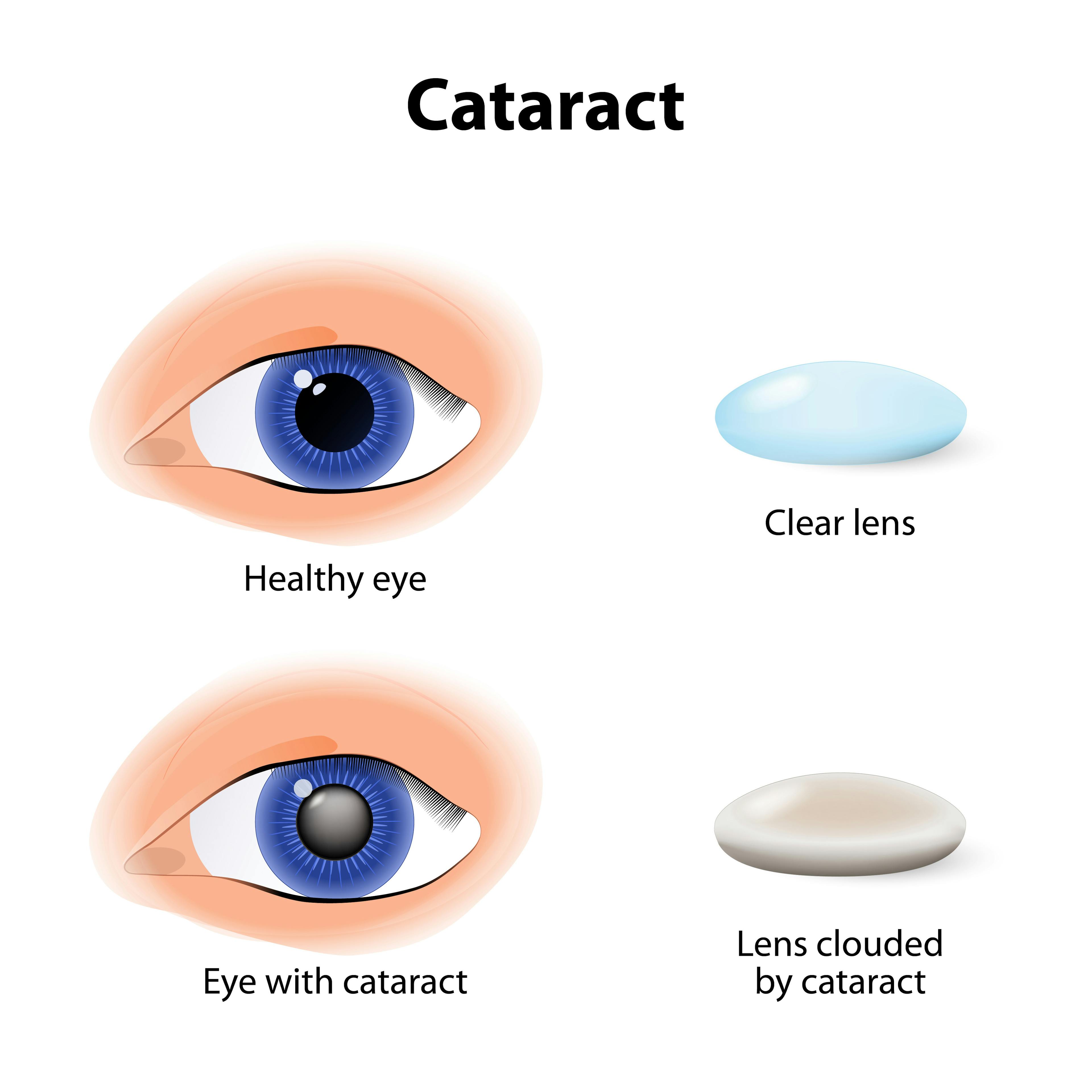Diagram comparing a healthy eye to an eye with cataract. The top left shows a healthy blue eye with a clear, bright pupil, labeled 'Healthy eye.' To the right, a transparent blue lens is labeled 'Clear lens.' The bottom left displays an eye with a cataract, where the pupil appears cloudy or gray, labeled 'Eye with cataract.' To the right of that, a cloudy, opaque lens is labeled 'Lens clouded by cataract.' The title 'Cataract' appears at the top.