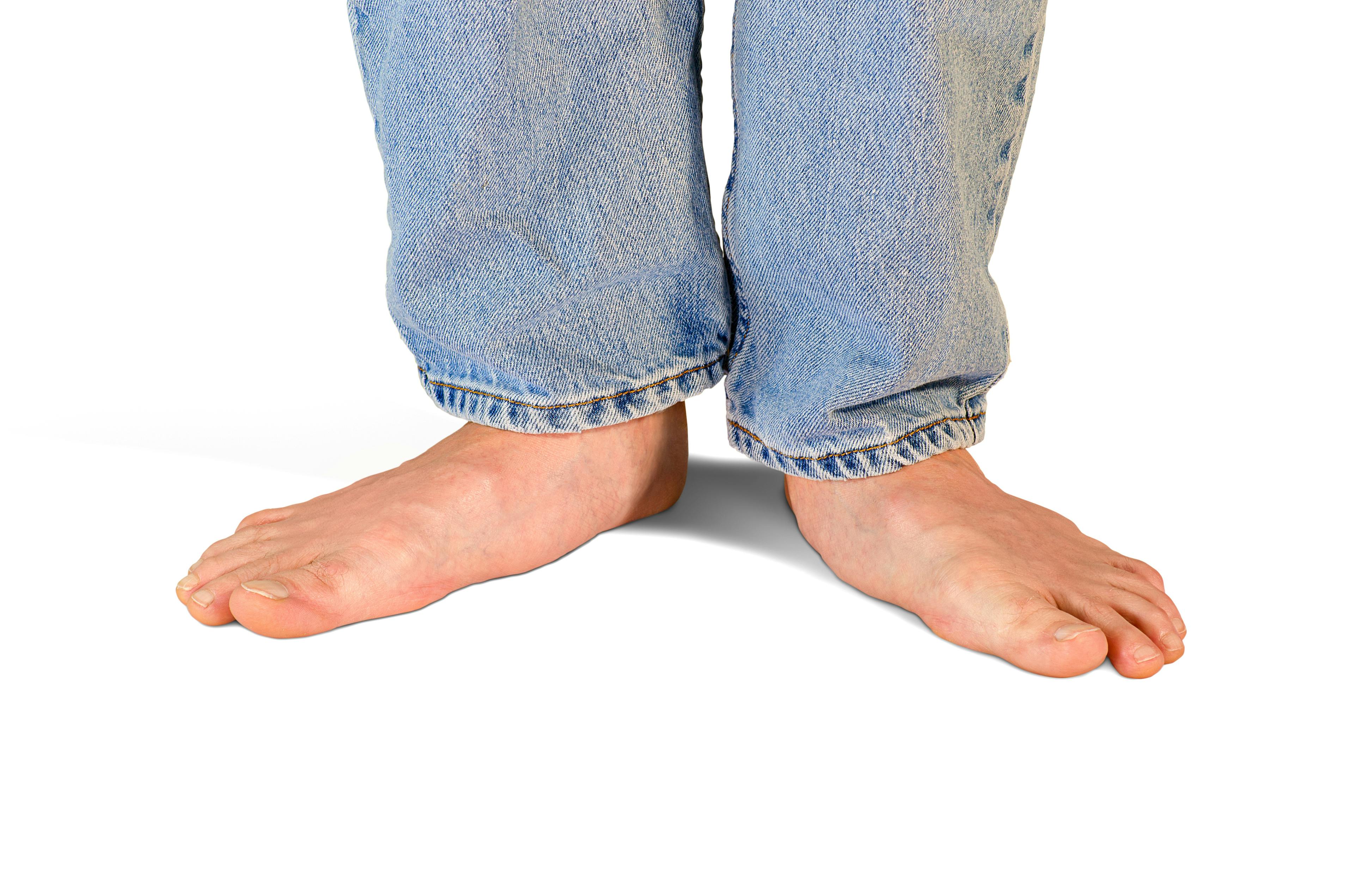 Bare feet with visible flat arches standing on a white background, wearing light blue jeans. The image illustrates flat feet, also known as fallen arches.