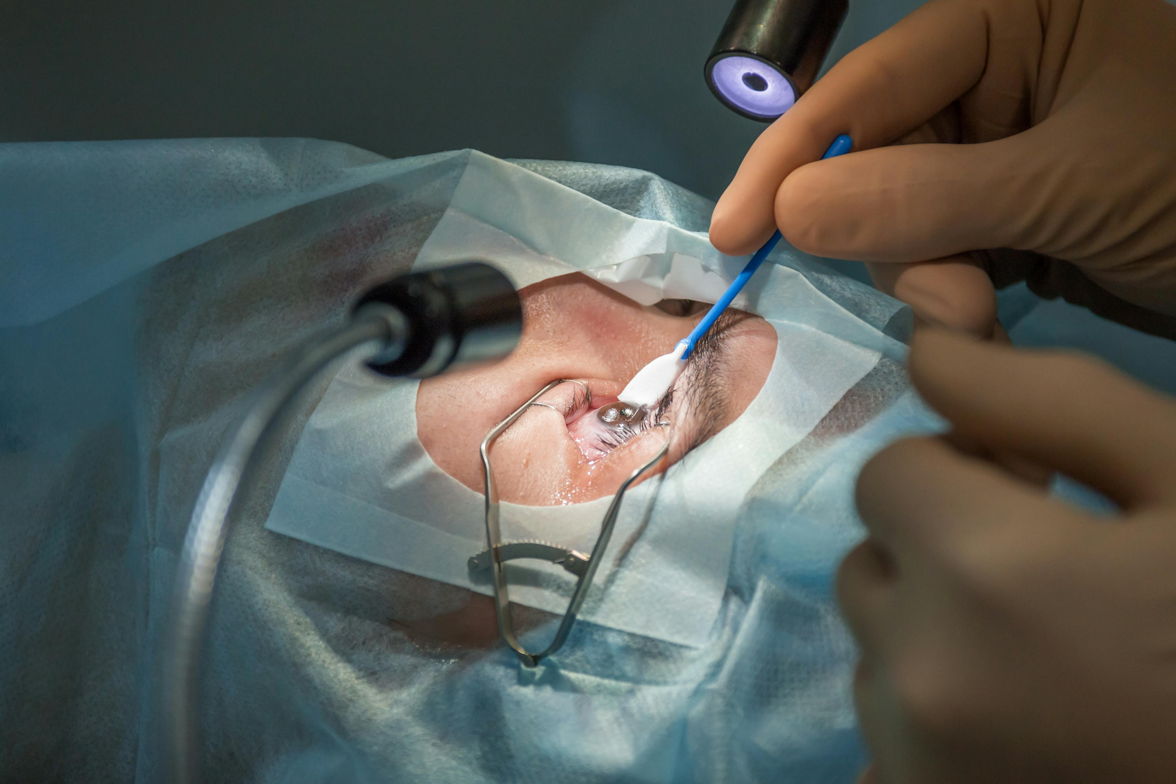Close-up of a patient undergoing LASIK eye surgery, with a metal speculum holding the eyelids open and a surgical instrument in use under a bright operating light.