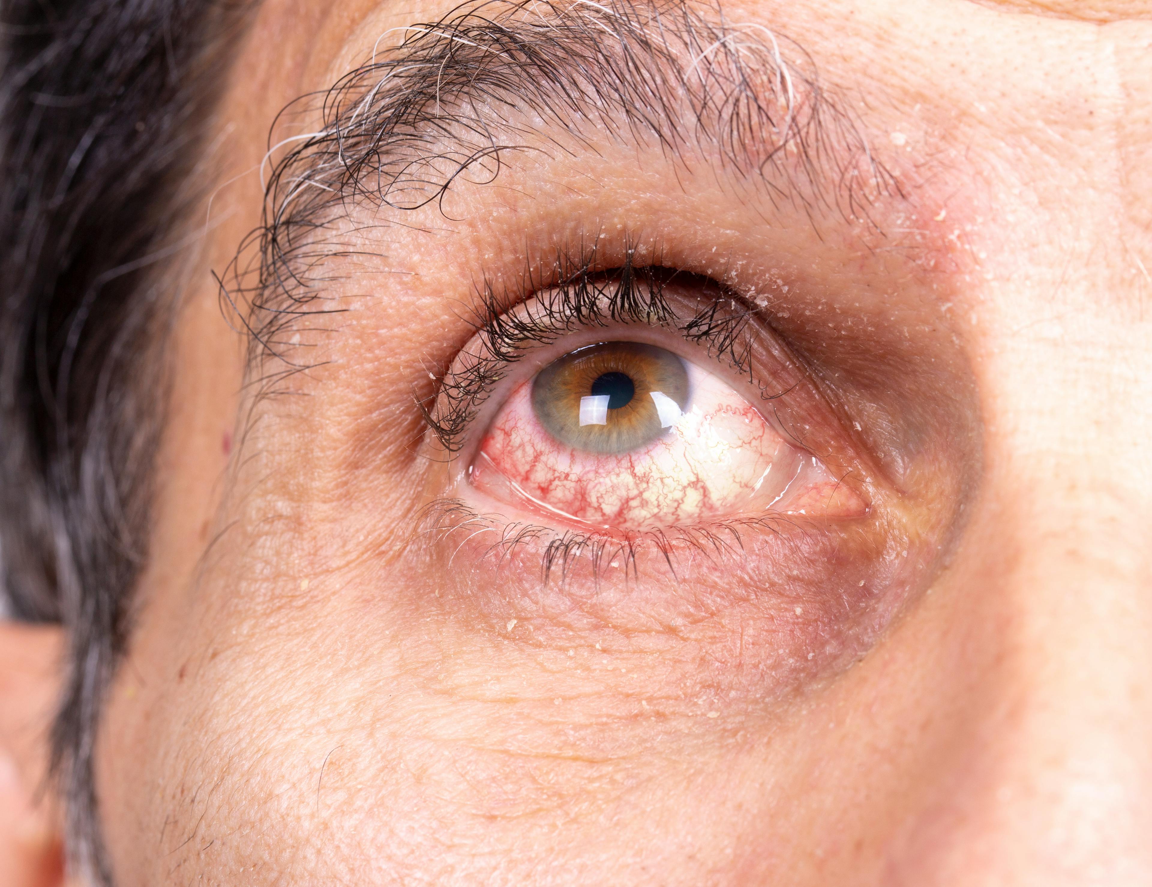 Human eye of a man suffering from uveitis. Noticeable redness of the sclera due to irritated capillaries.