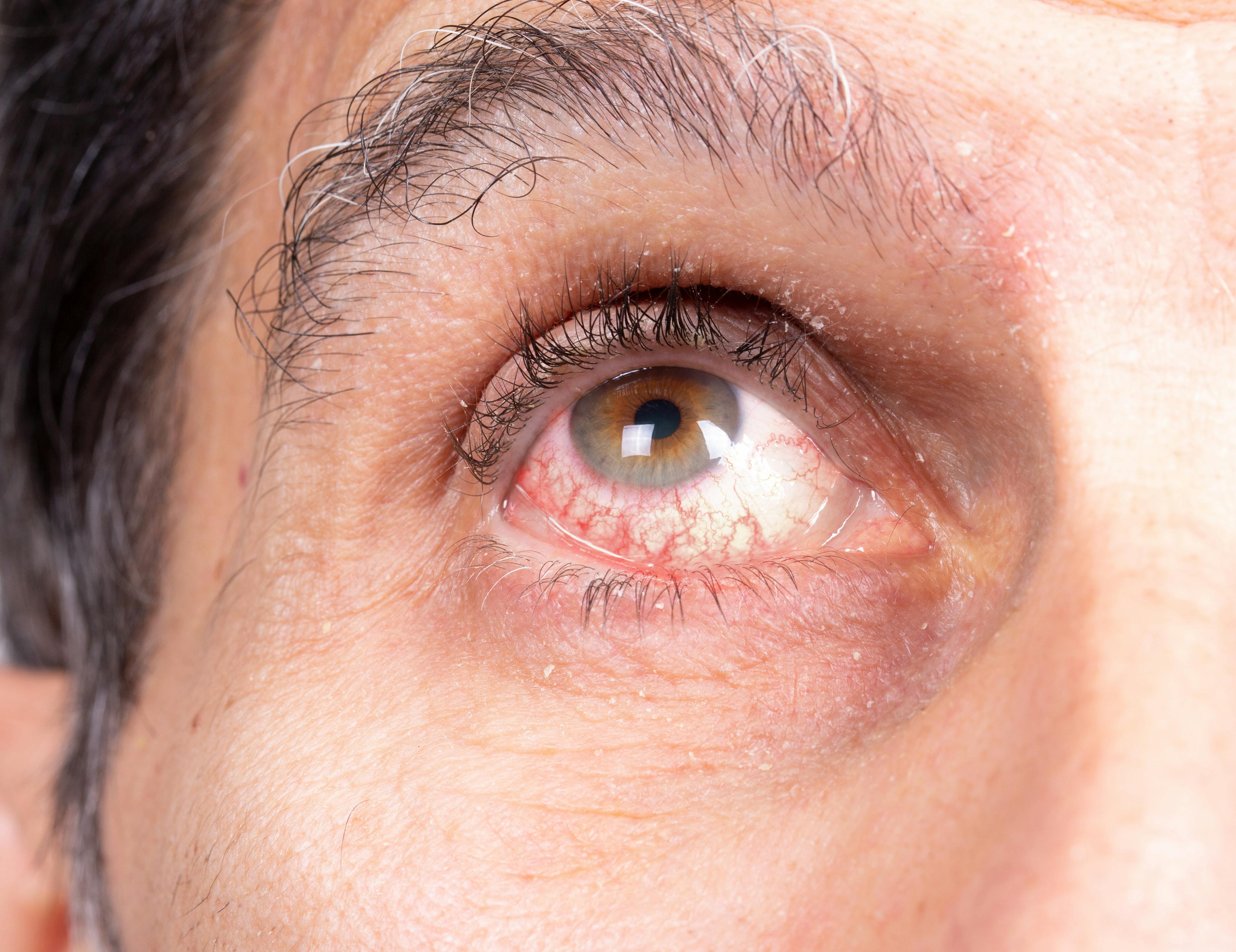 Human eye of a man suffering from uveitis. Noticeable redness of the sclera due to irritated capillaries.