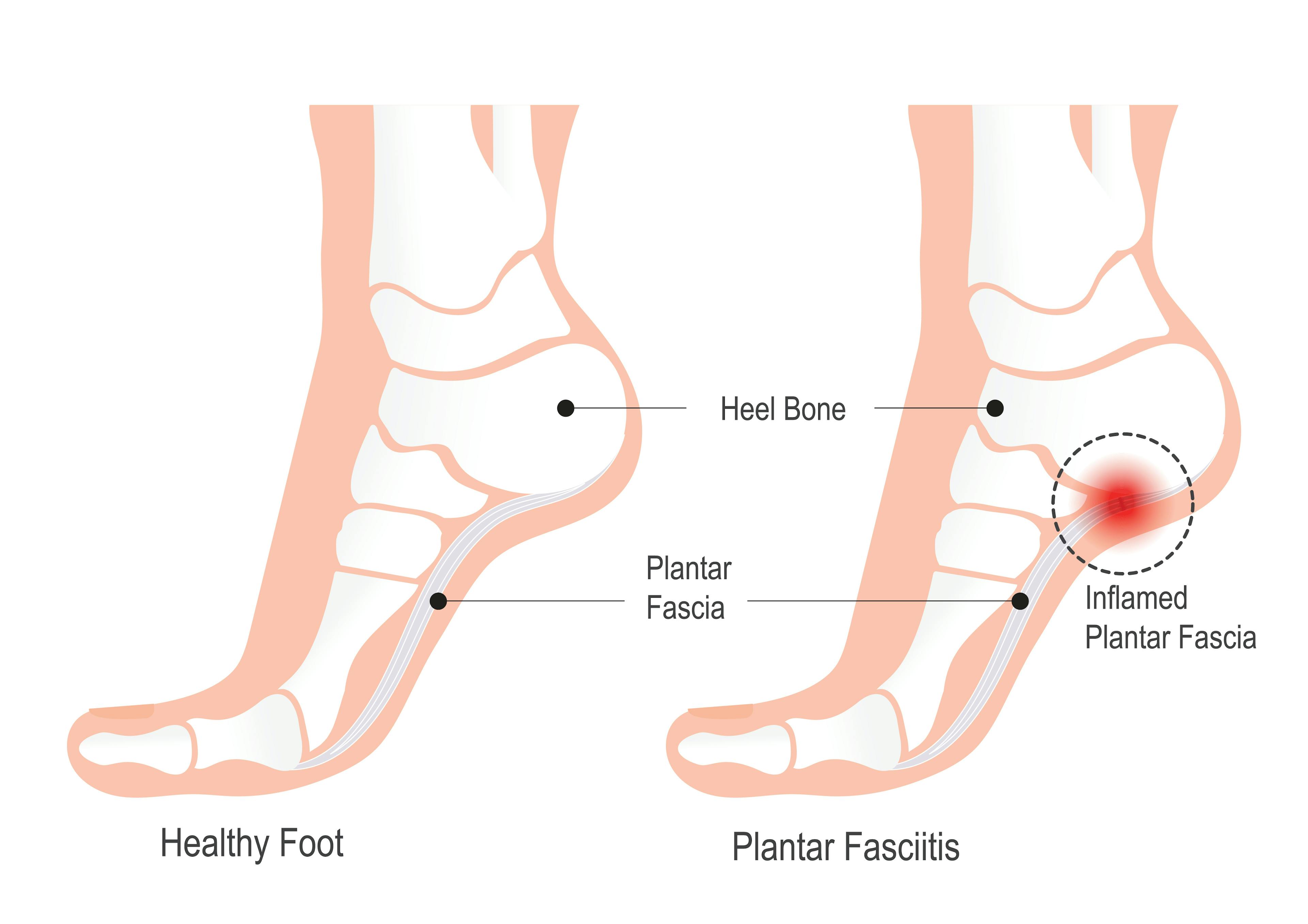 A person sitting on a carpeted floor holding the bottom of their foot with both hands, applying pressure to the heel and arch—suggesting foot pain or discomfort commonly associated with plantar fasciitis.