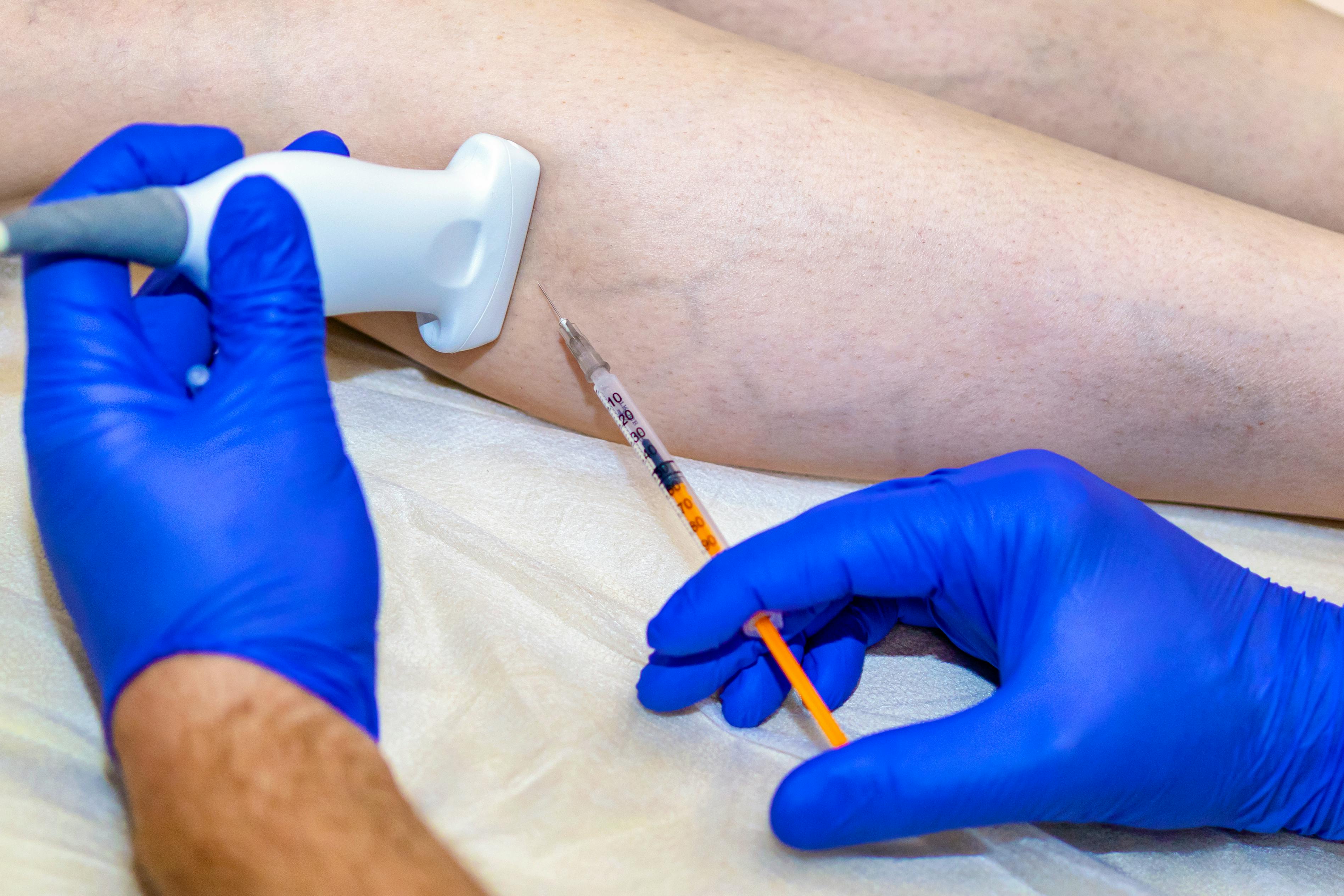 Close-up of a medical professional using ultrasound guidance while performing a sclerotherapy injection into a patient’s leg to treat visible veins, such as spider veins or varicose veins.