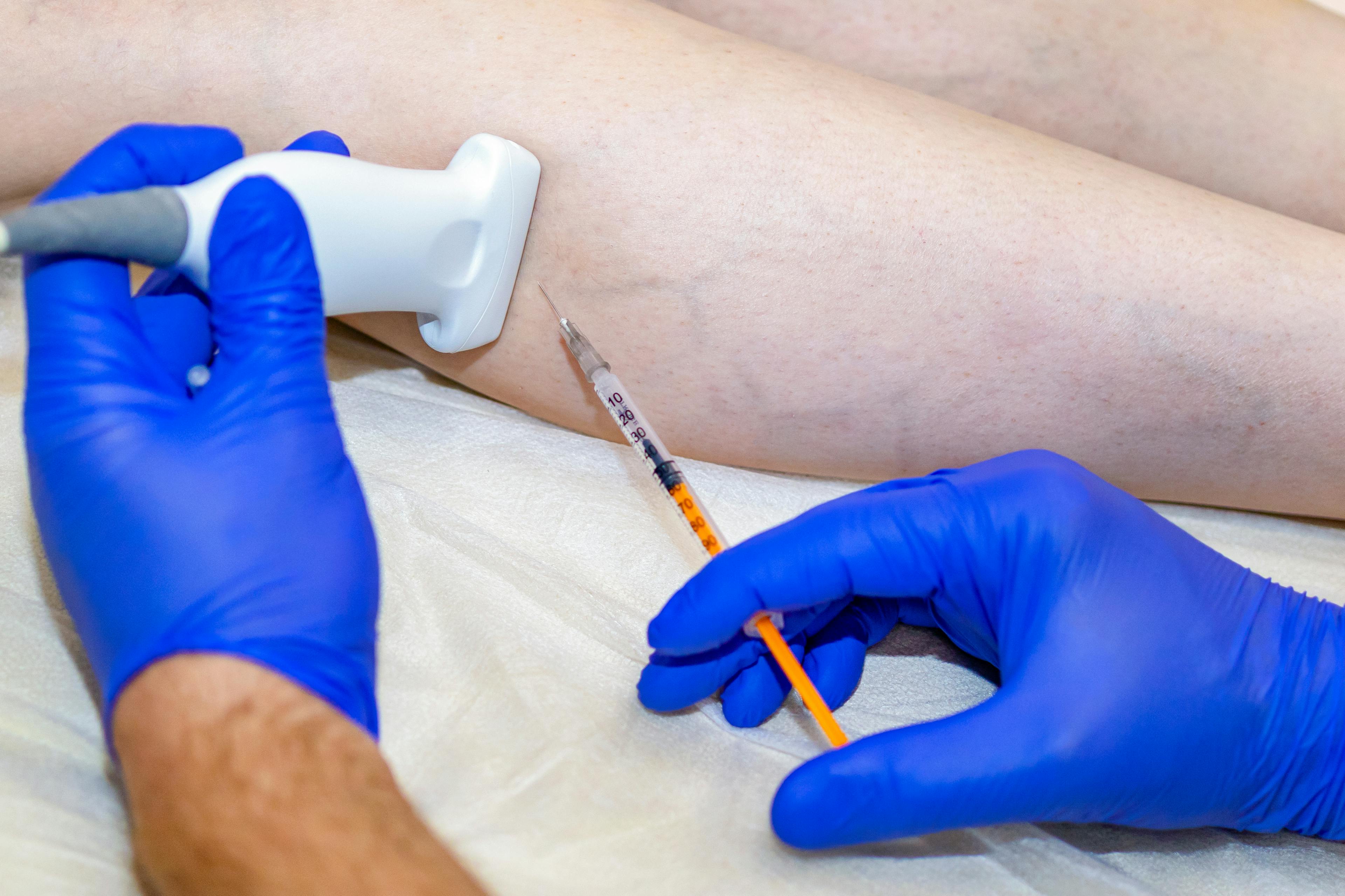 Close-up of a medical professional using ultrasound guidance while performing a sclerotherapy injection into a patient’s leg to treat visible veins, such as spider veins or varicose veins.