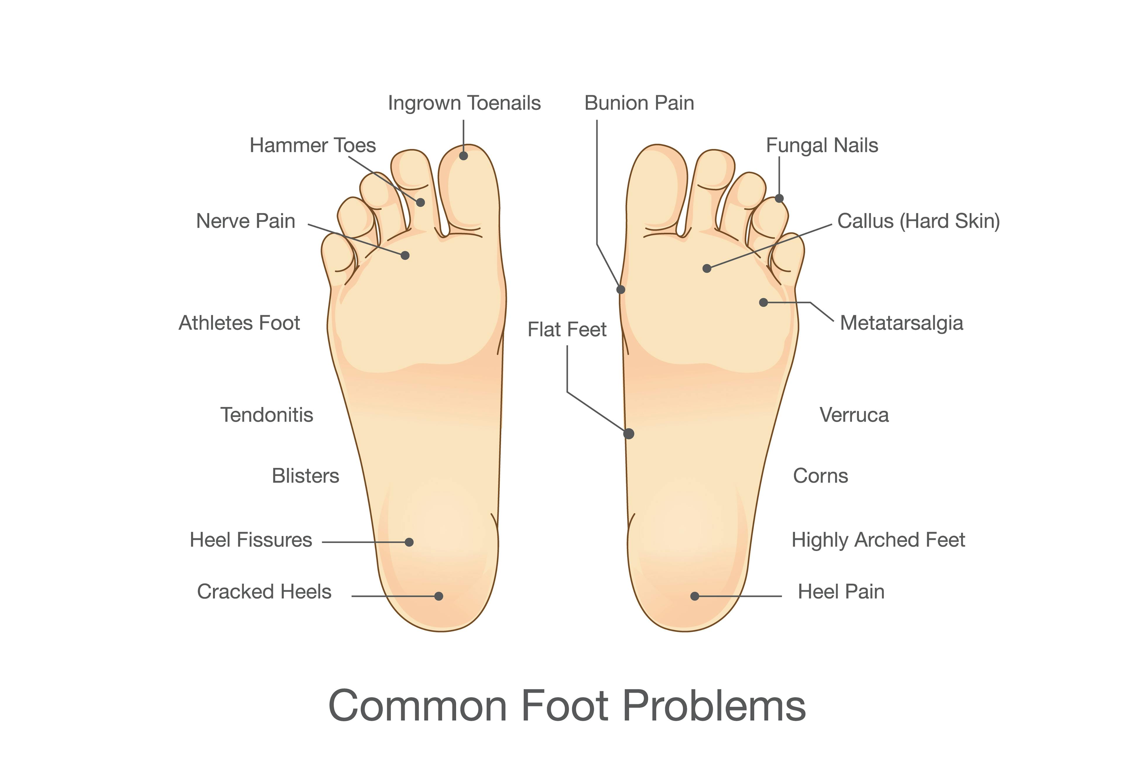 Diagram of two feet labeled with common foot problems, including heel pain, bunions, ingrown toenails, plantar nerve pain, hammer toes, flat feet, and others.