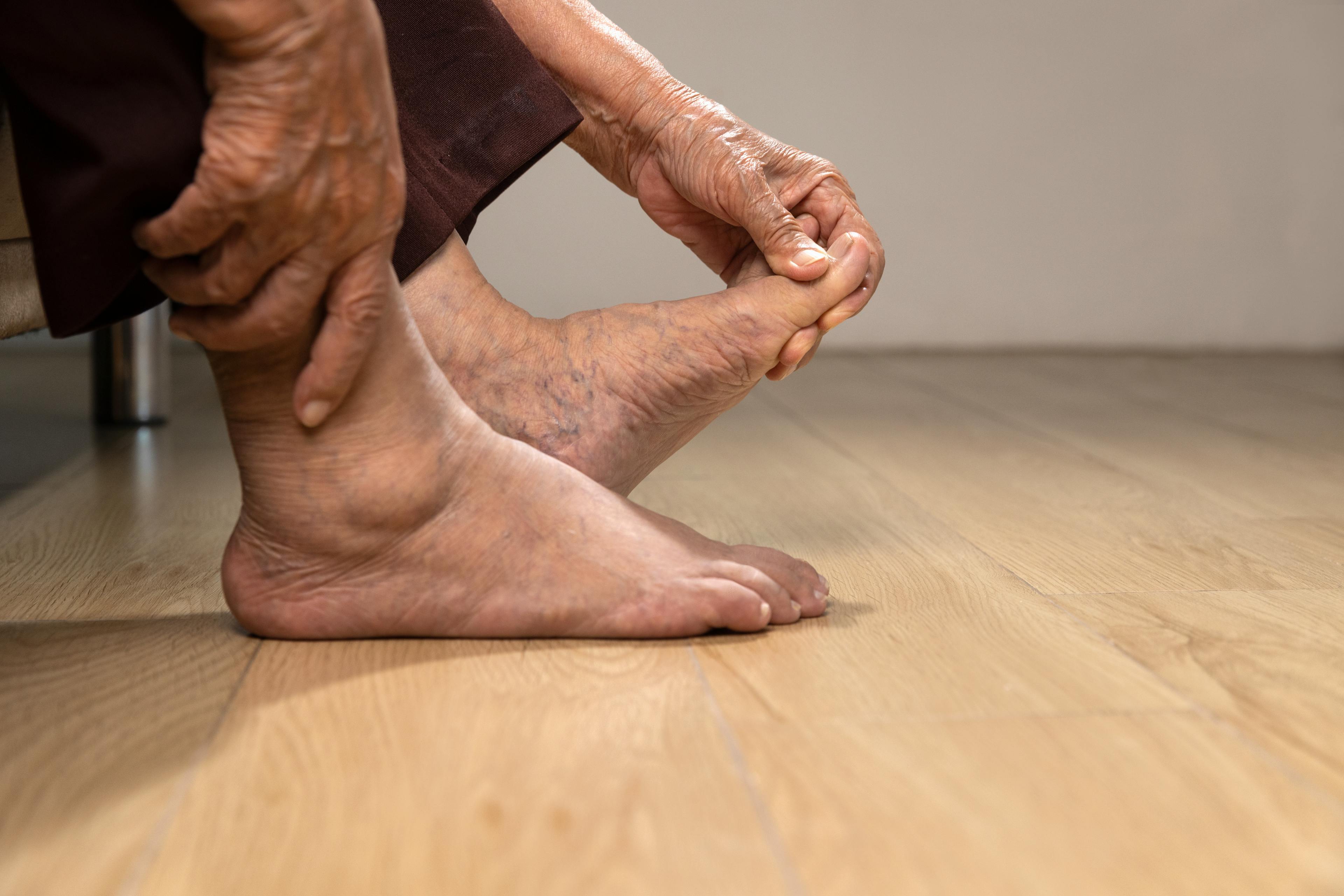 Senior woman massages foot with painful swollen gout inflammation.