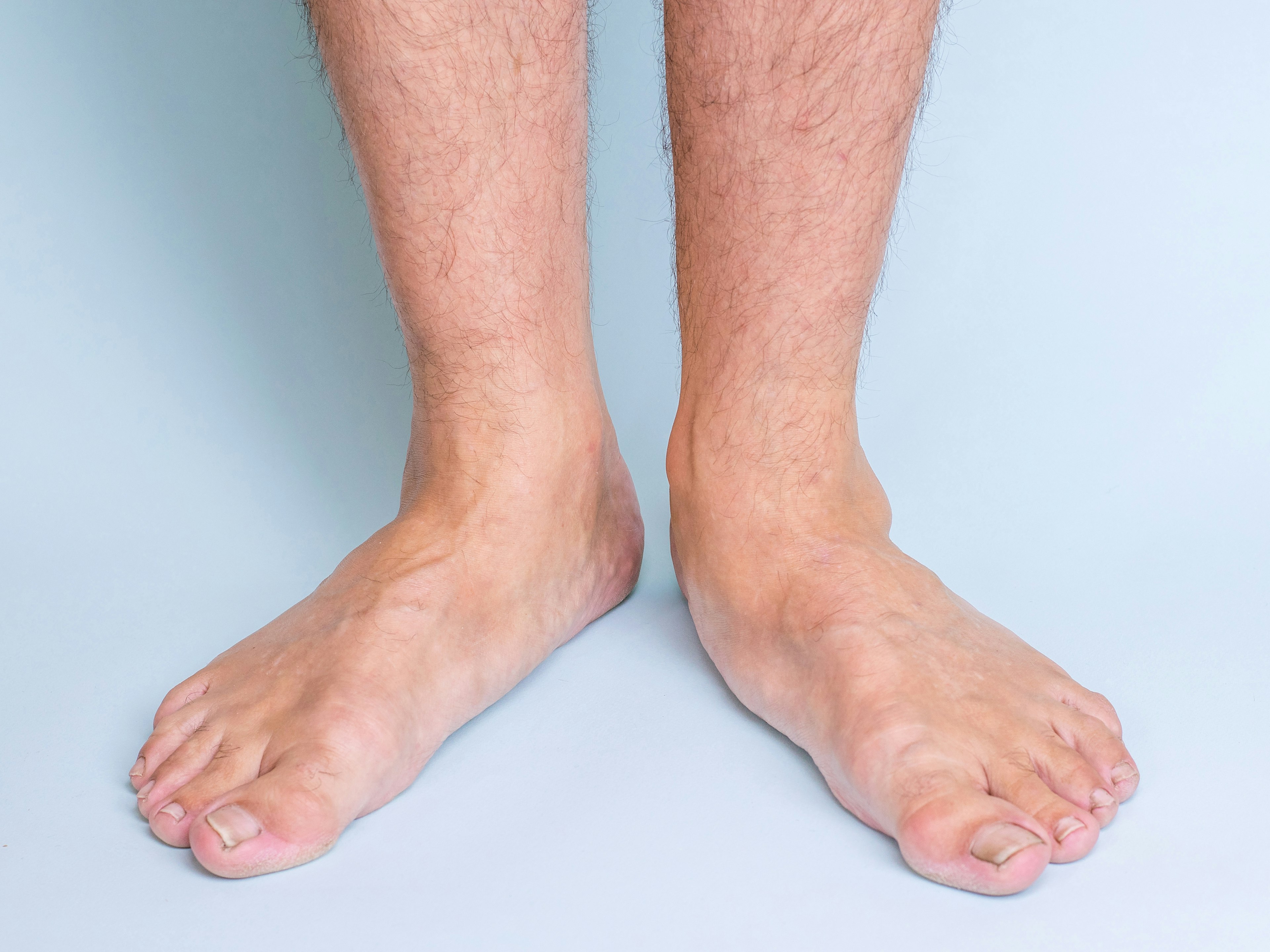 Close-up of bare feet with visible fallen arches, commonly known as flat feet, standing on a light blue background.