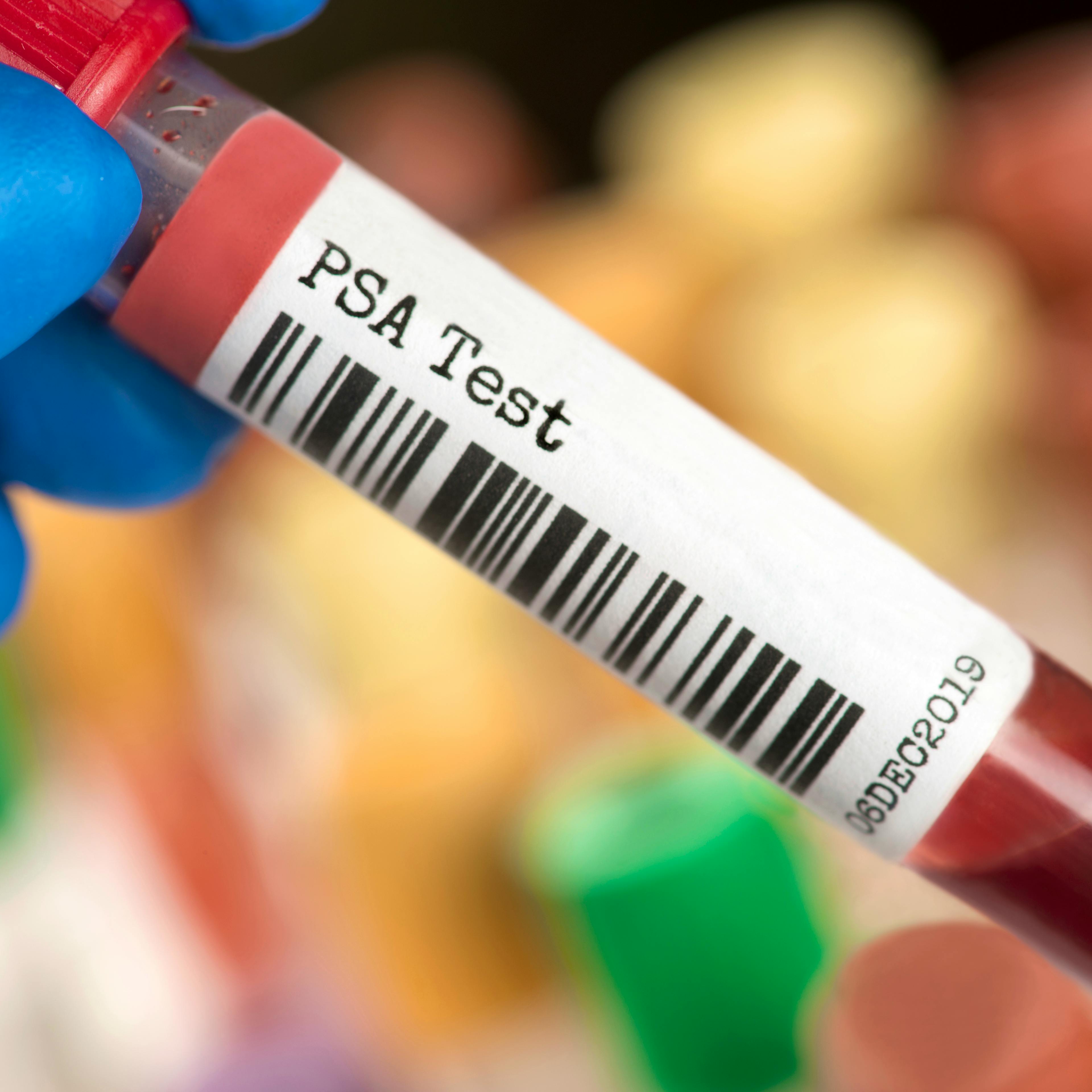 Close-up of a gloved hand holding a vial labeled "PSA Test" containing a blood sample.