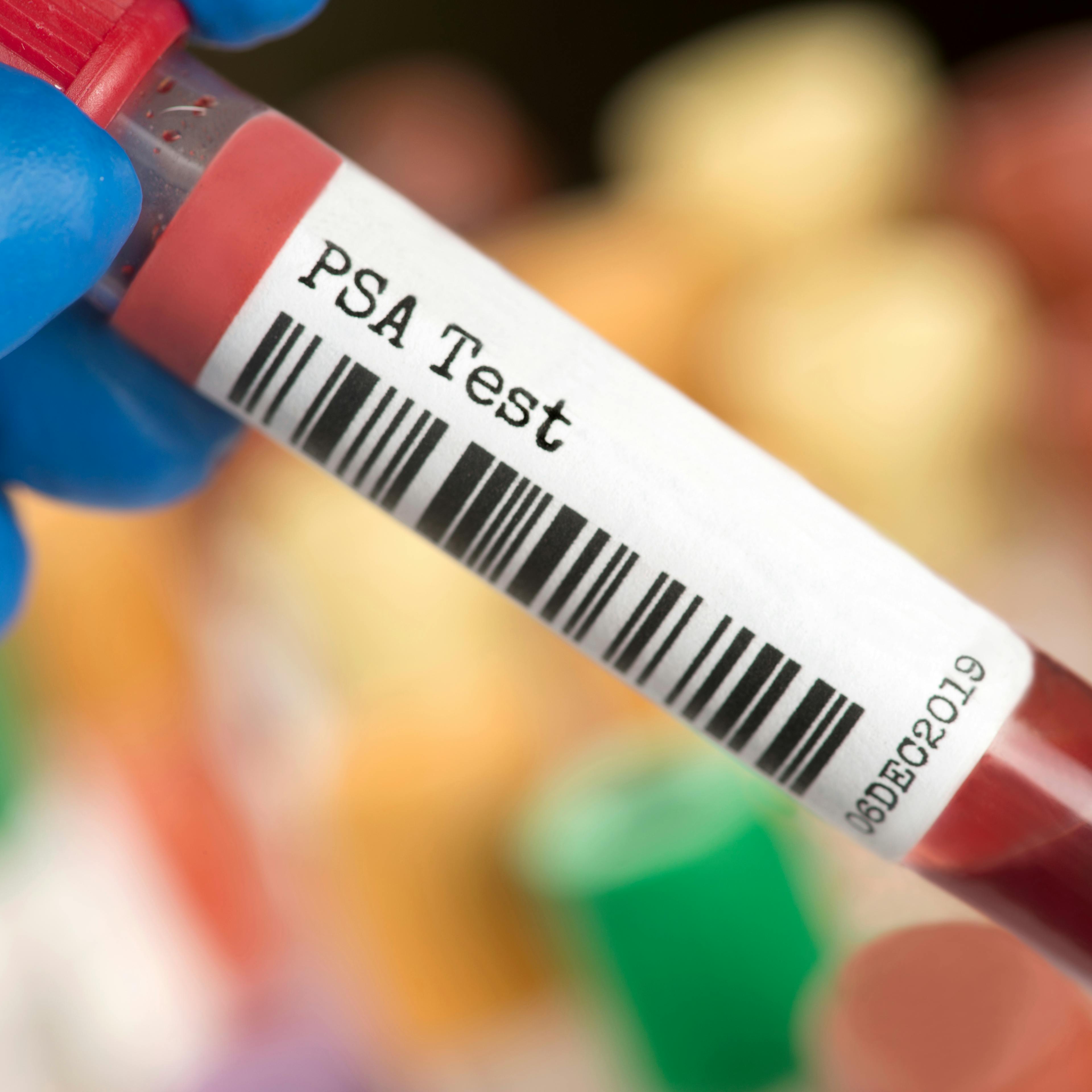 Close-up of a gloved hand holding a vial labeled "PSA Test" containing a blood sample.