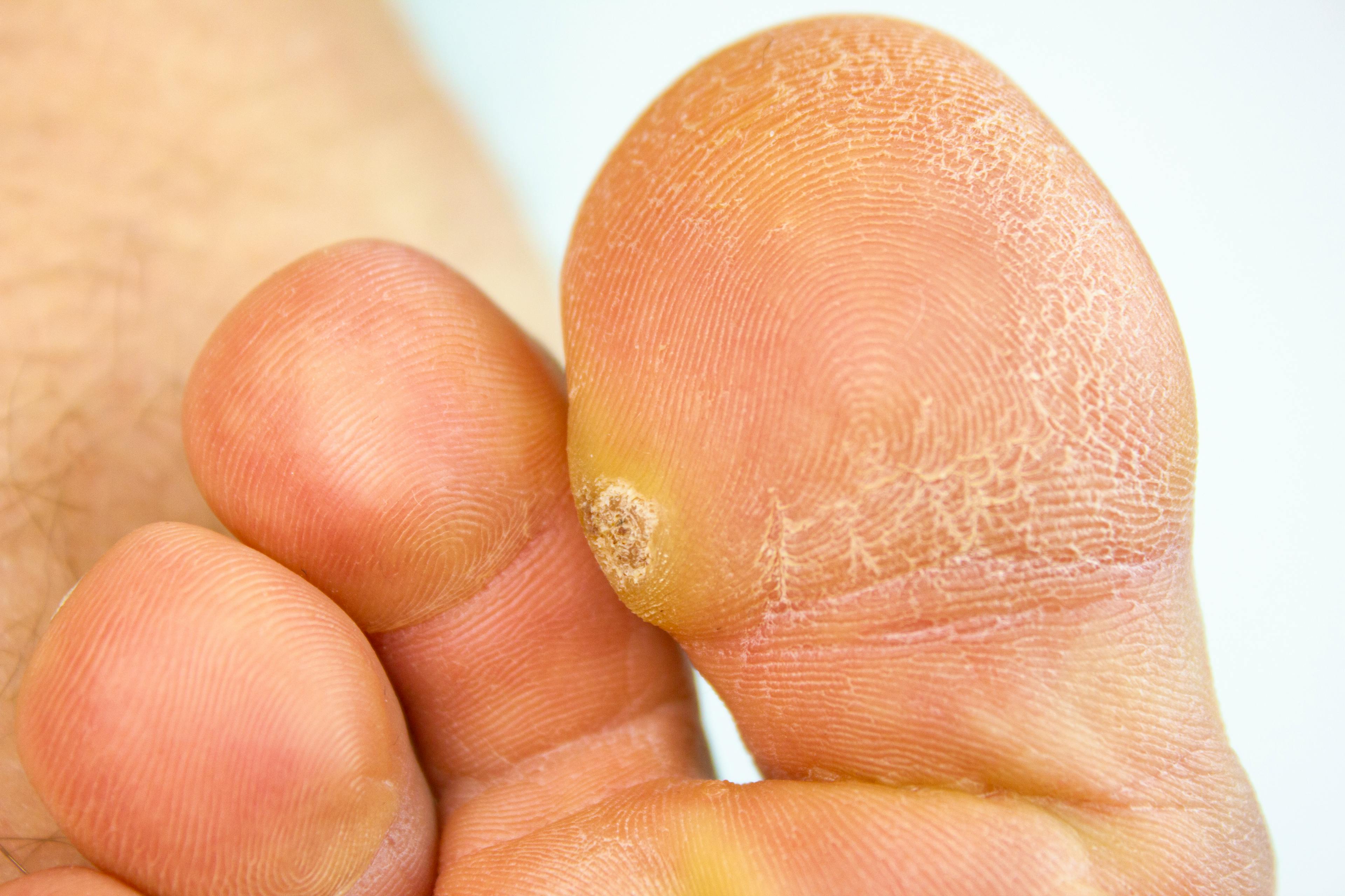 Plantar wart on inside of big toe.