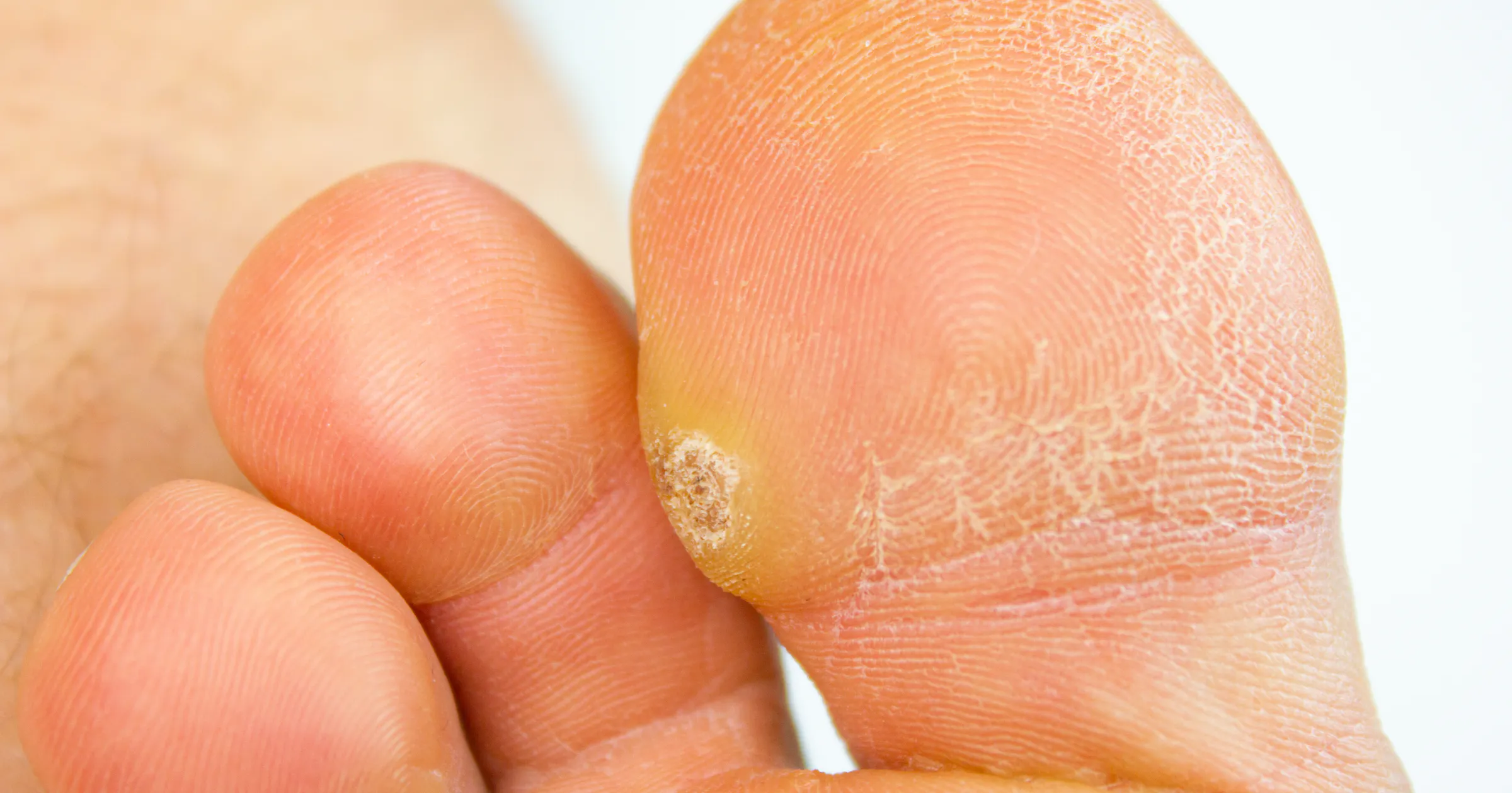 Plantar Wart Removal in Houston | Foot Wart Treatment | CLS Health ...