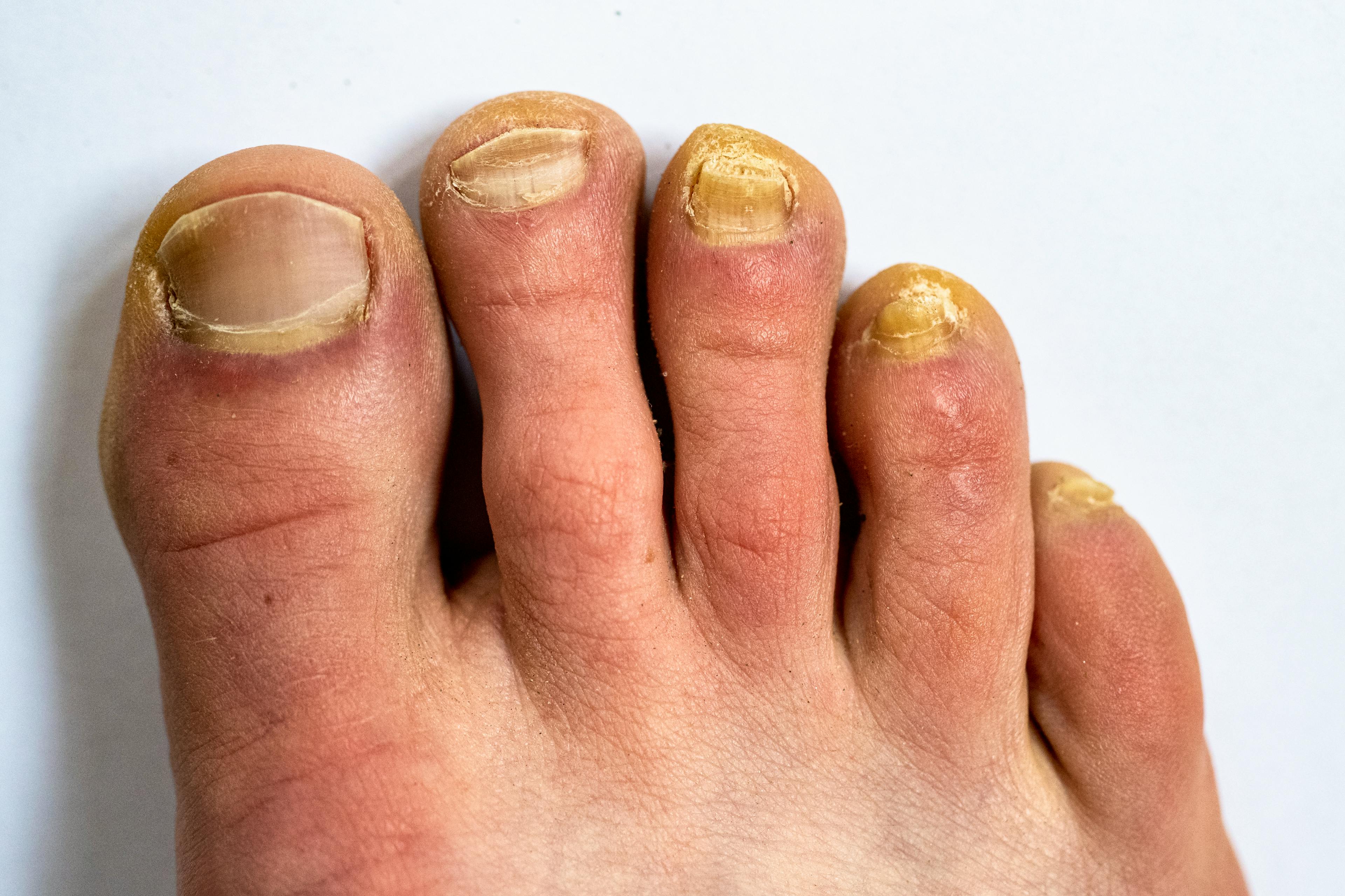 Adult male foot with nail fungal infection.