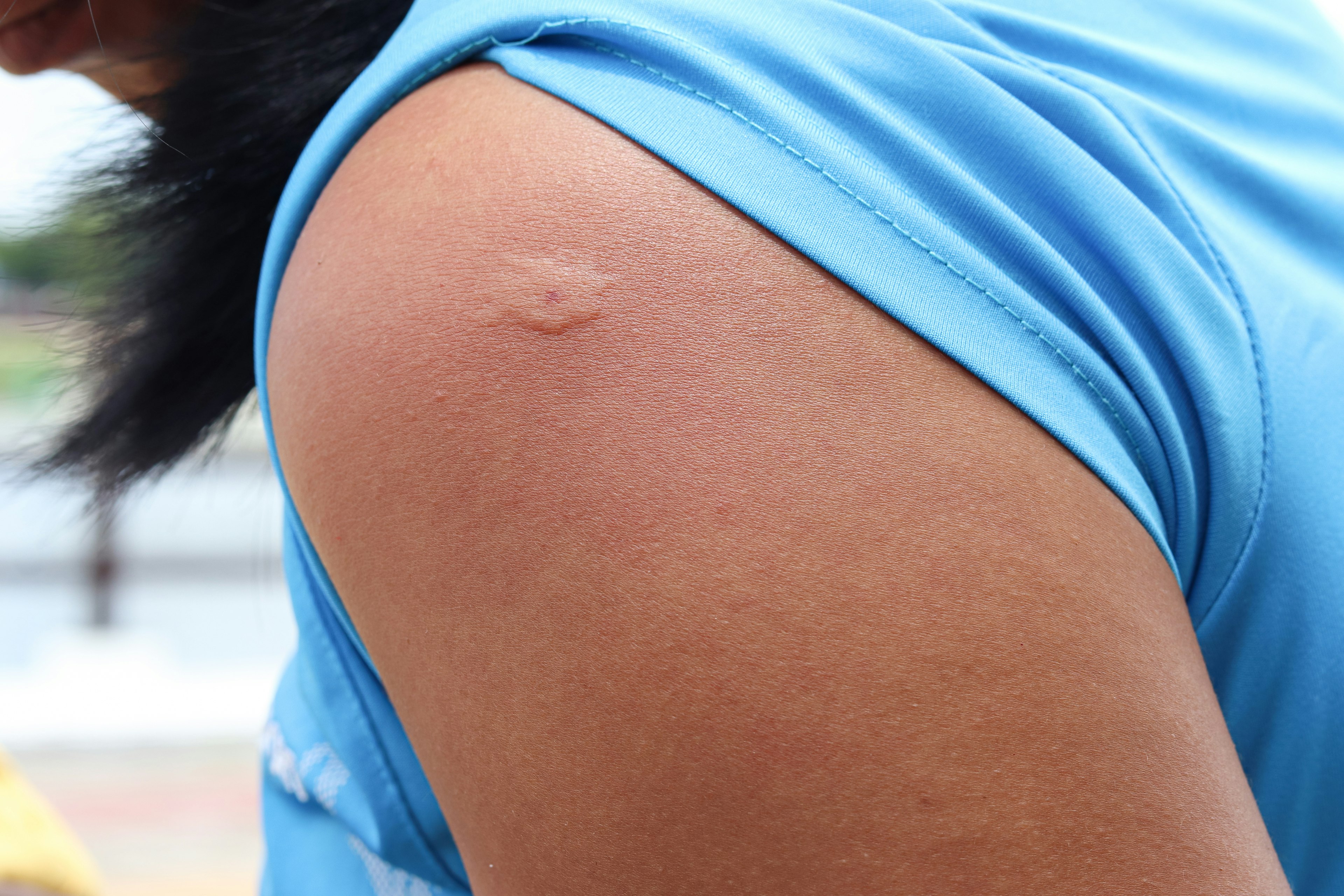 A man having a allergic reaction to a bee sting on his arm