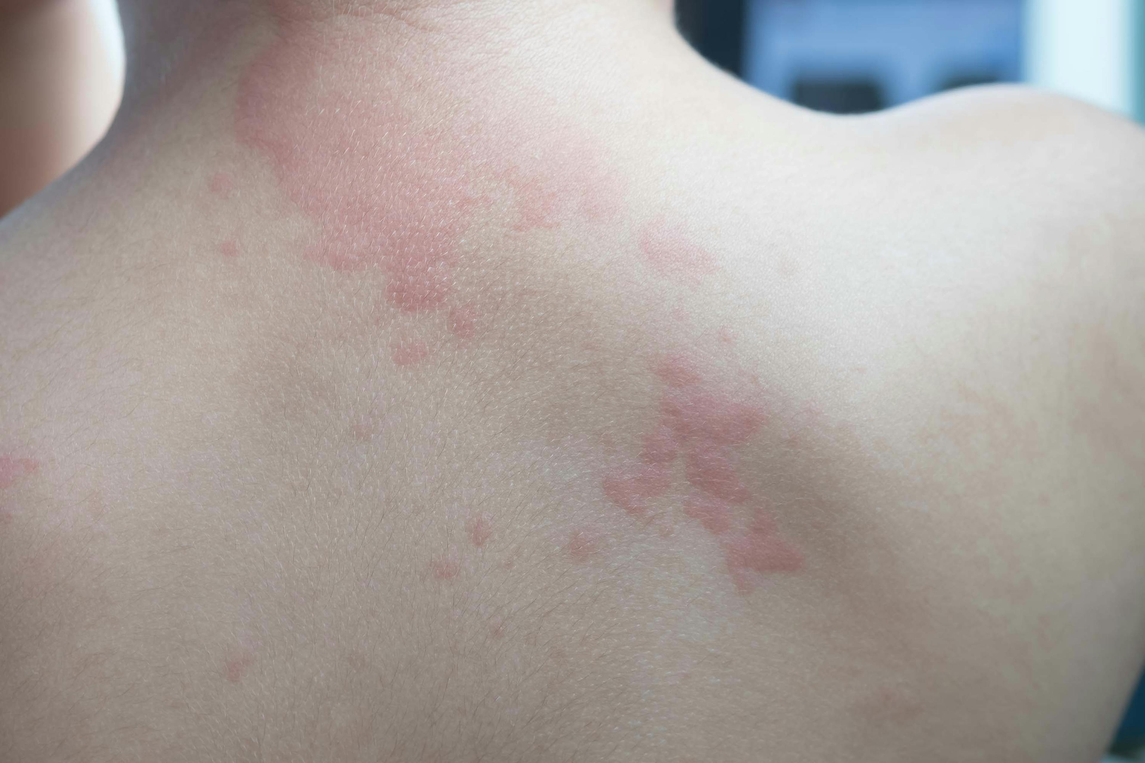 Close up of boy's body suffering from chronic hives