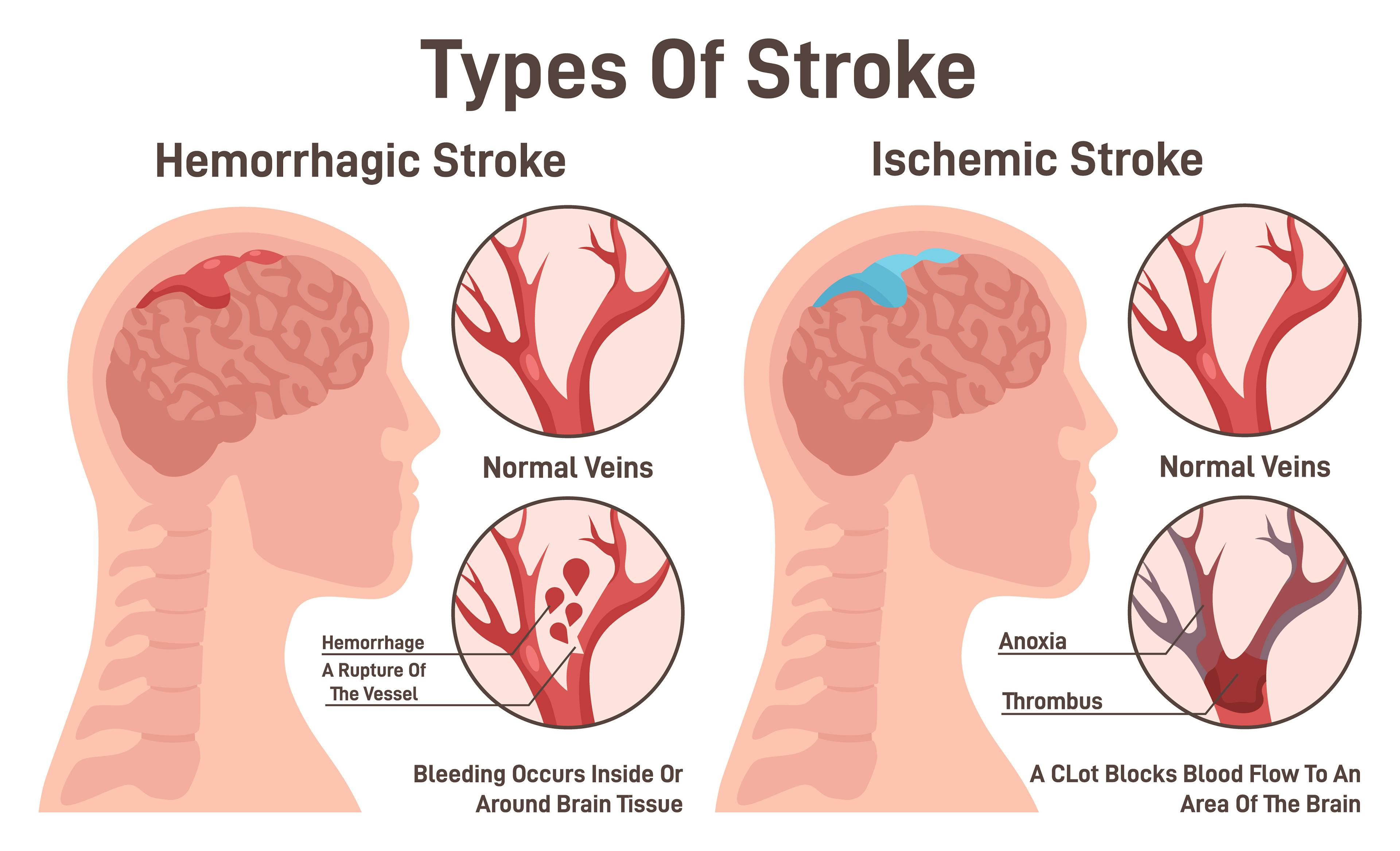 Graphic showing the differences between hemorrhagic and ischemic stroke.