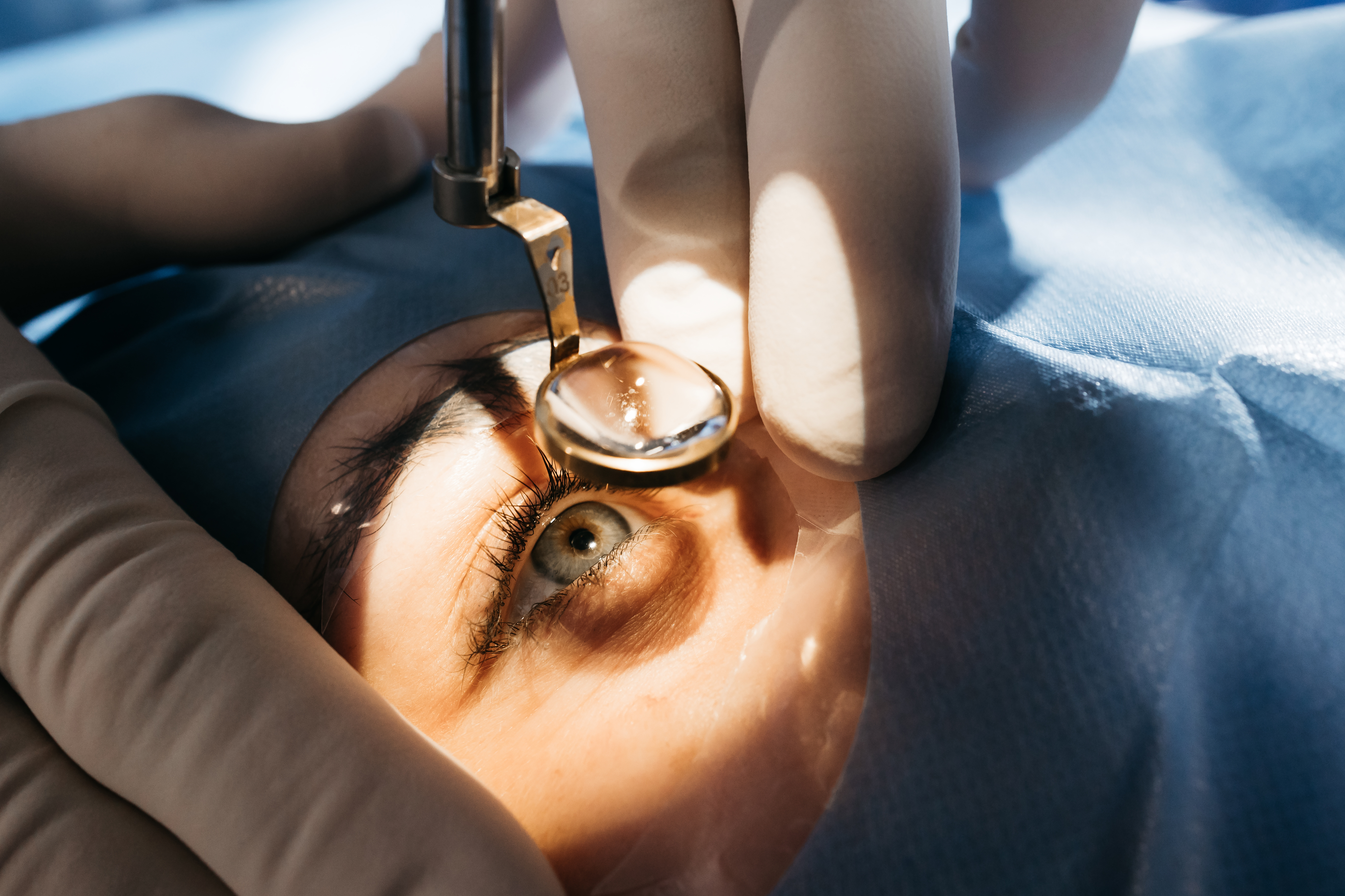 A close up of a patient's eye during eye surgery. 