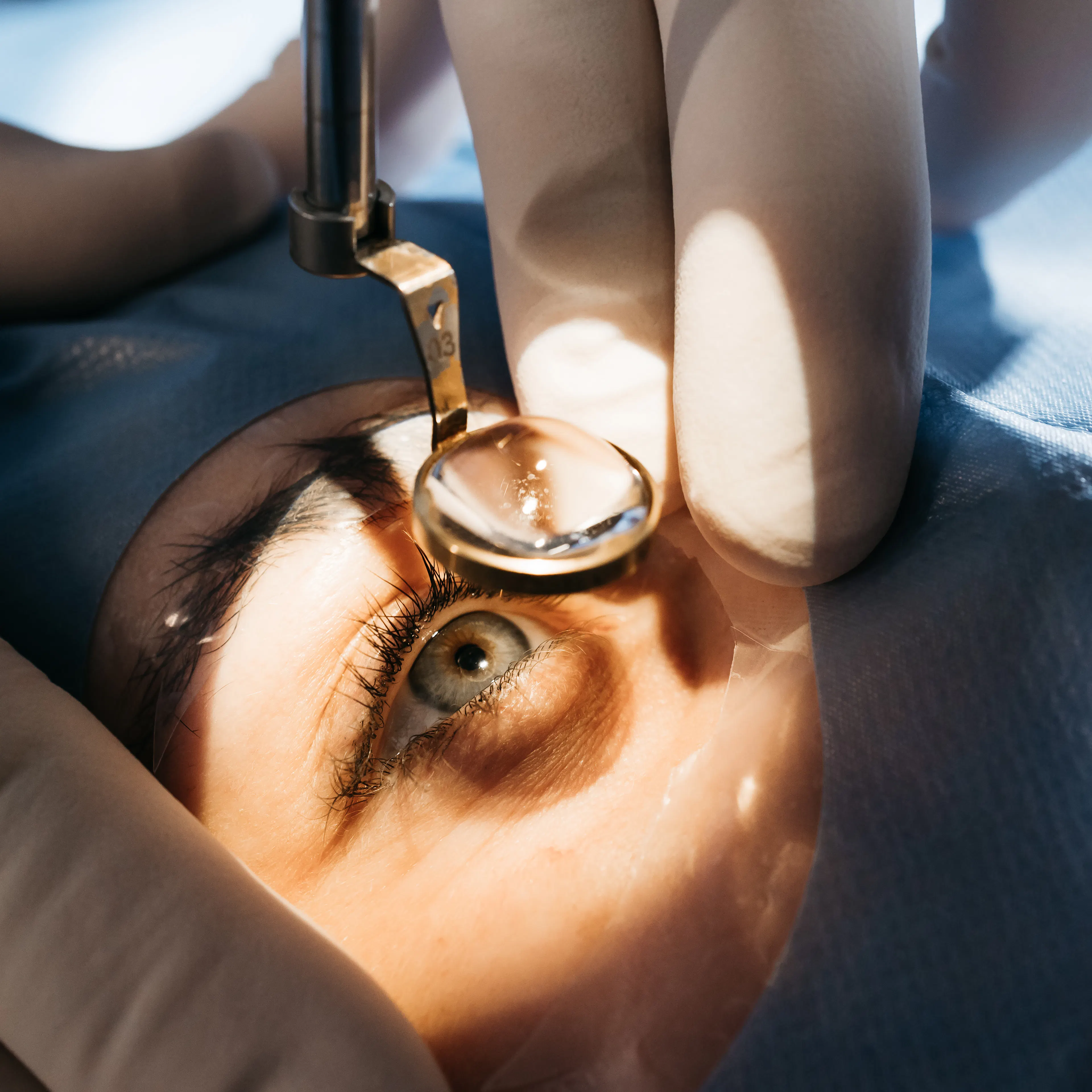 A close up of a patient's eye during eye surgery. 