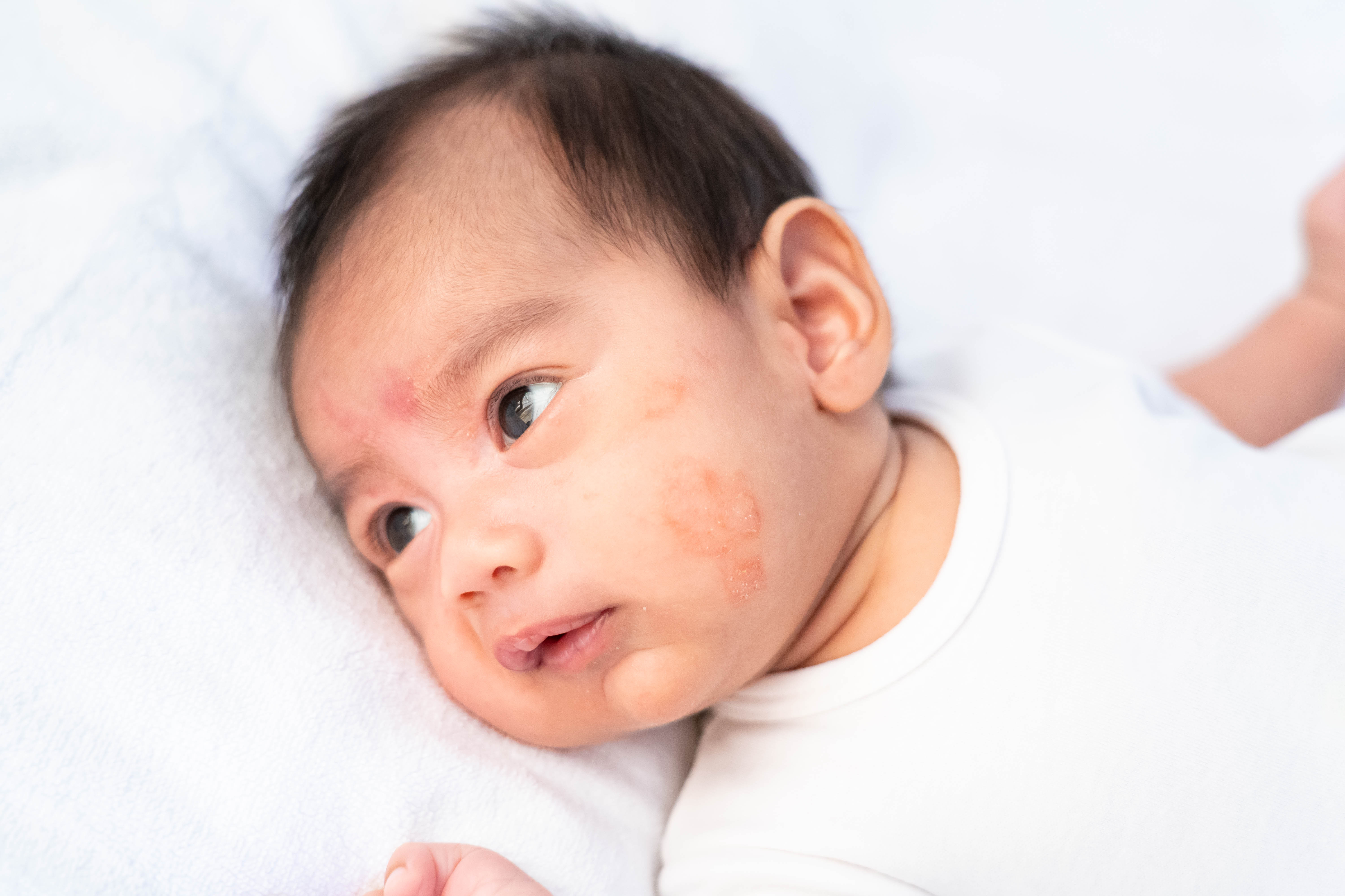 Close up of a baby's cheek with eczema.