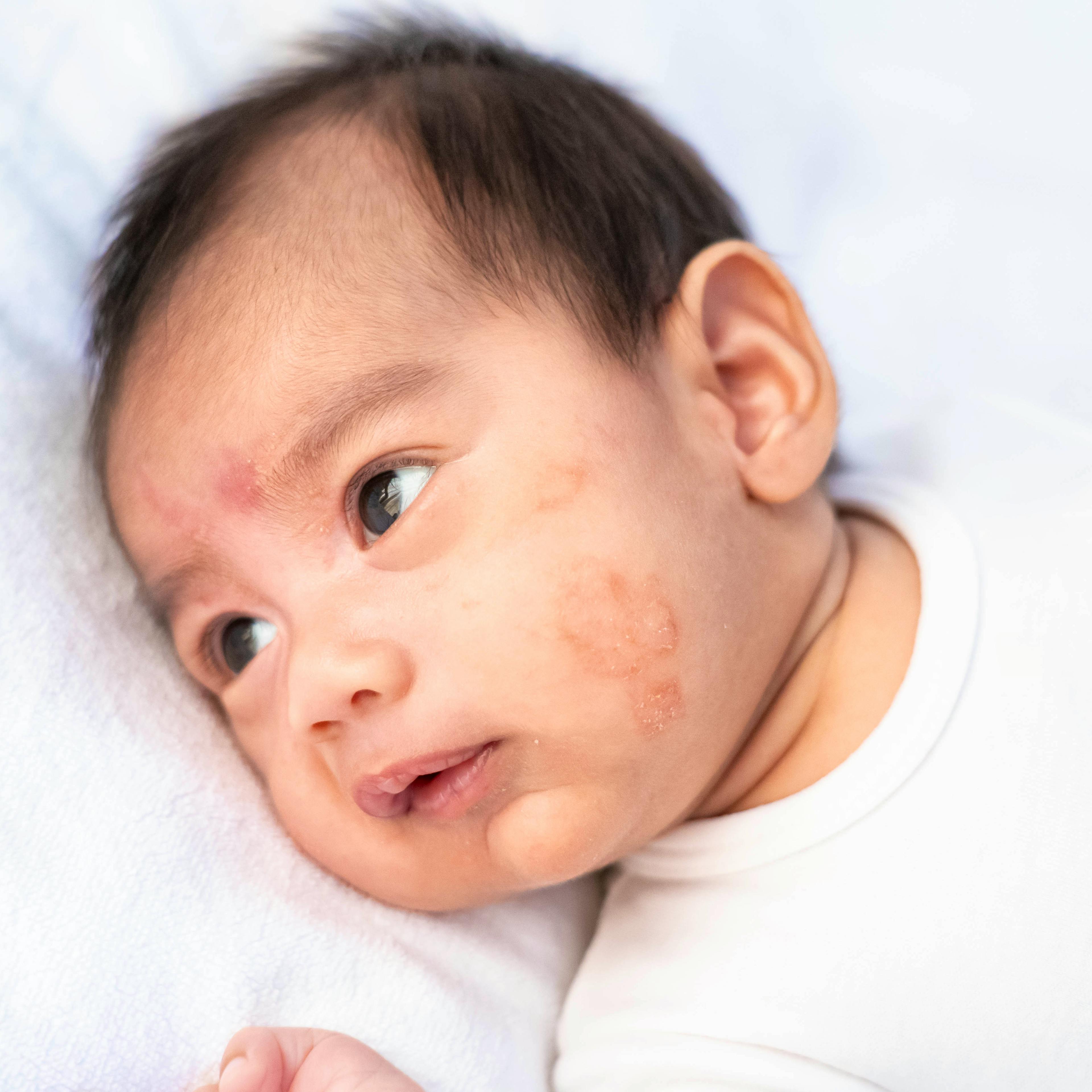 Close up of a baby's cheek with eczema.
