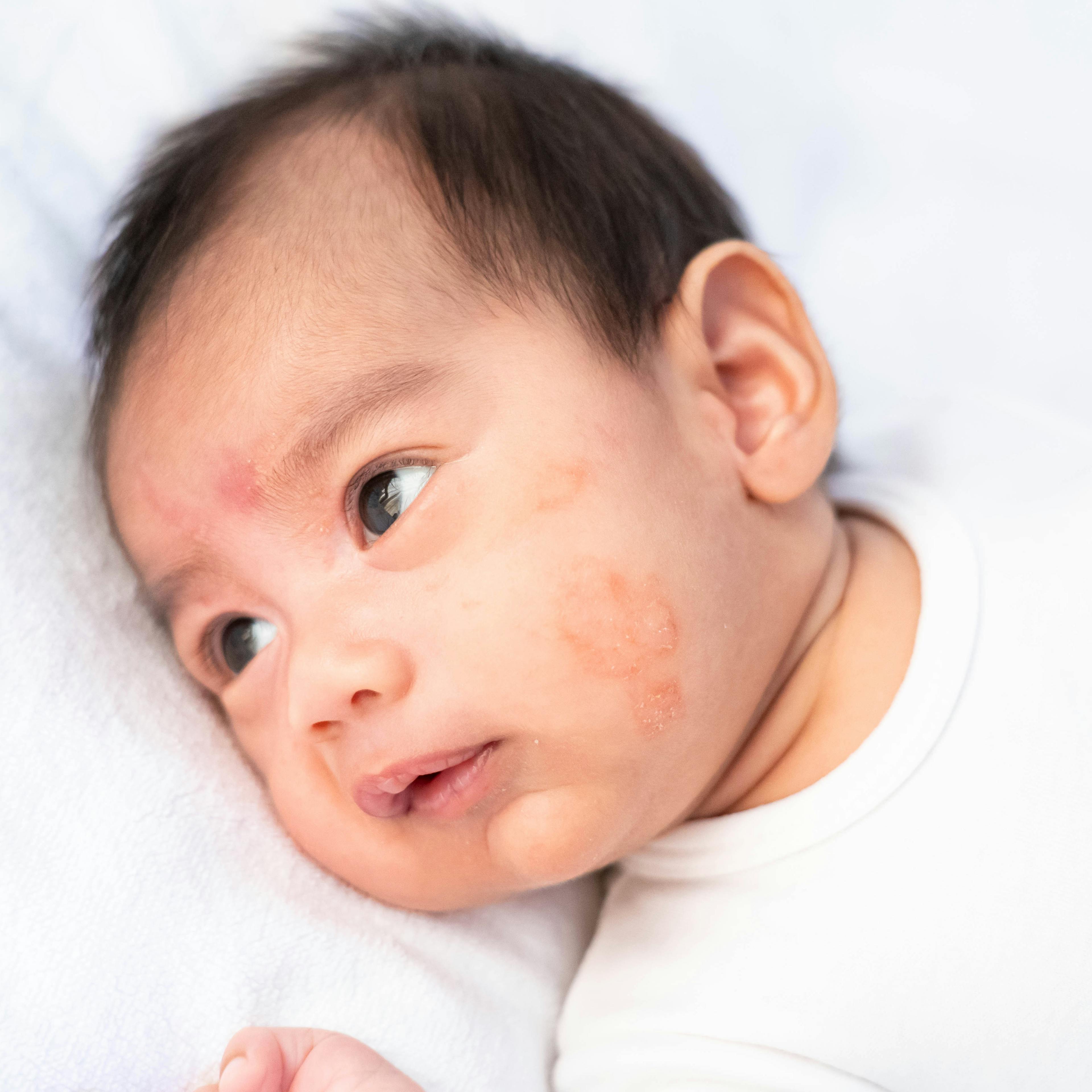 Close up of a baby's cheek with eczema.