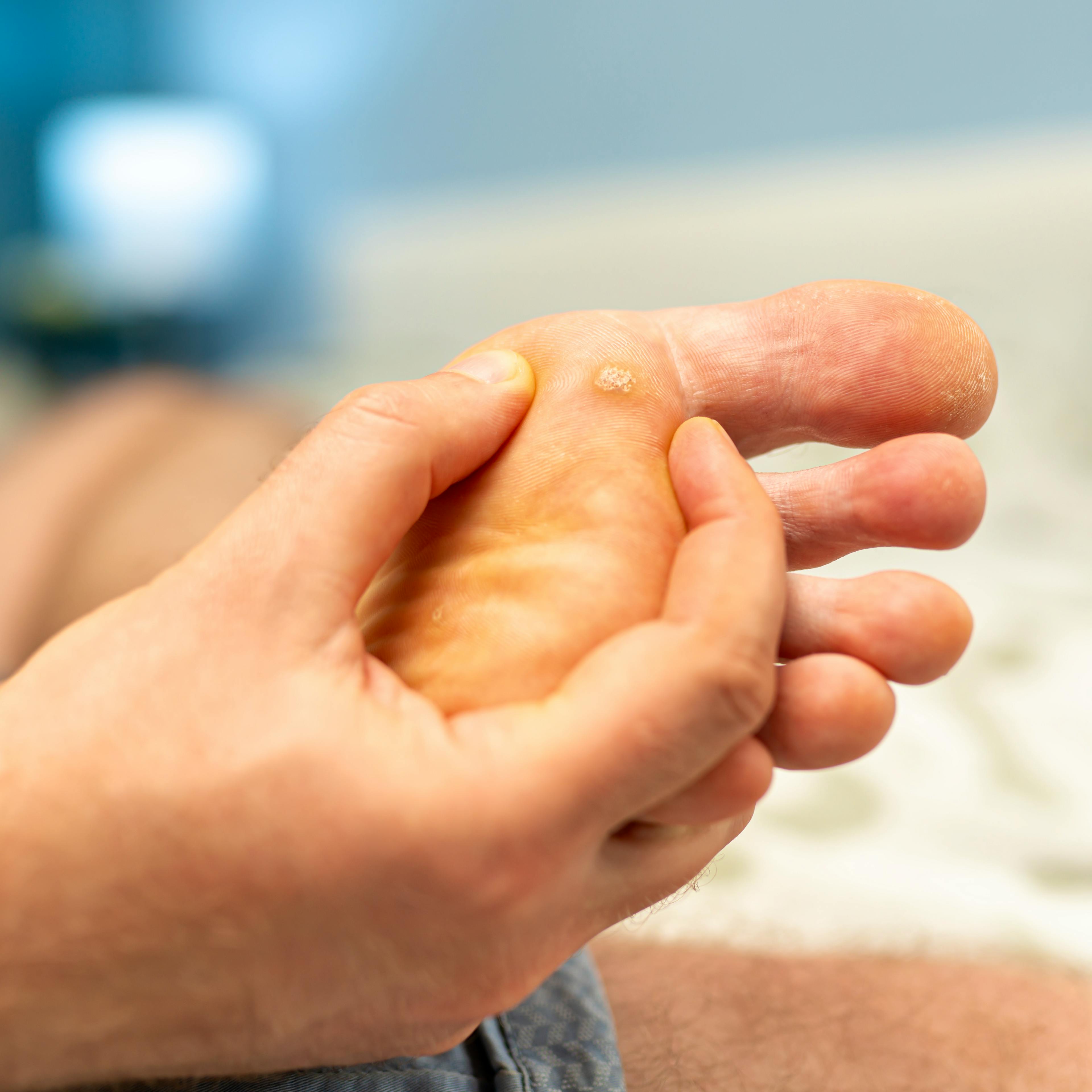 A close-up of plantar (feet) warts.