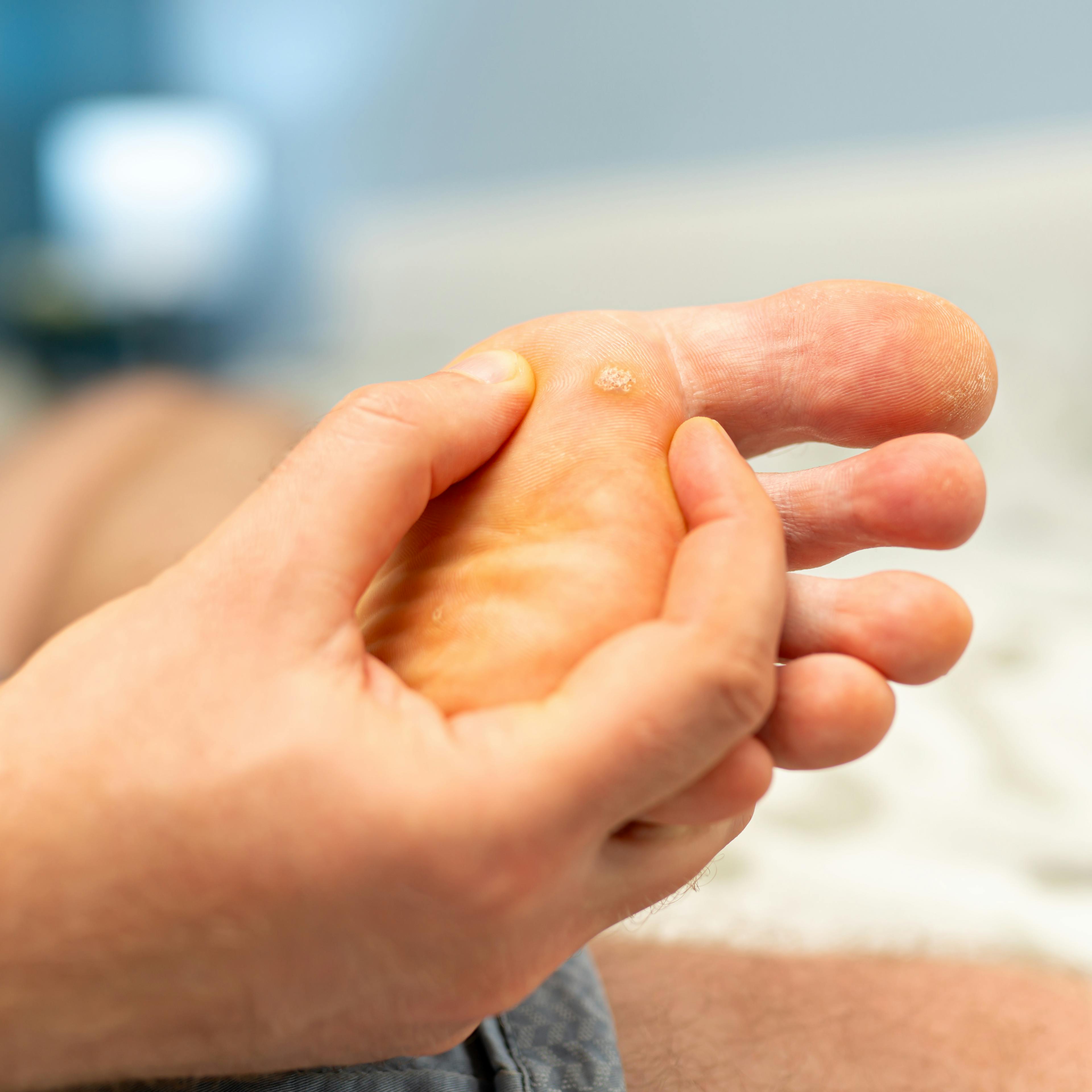 A close-up of plantar (feet) warts.