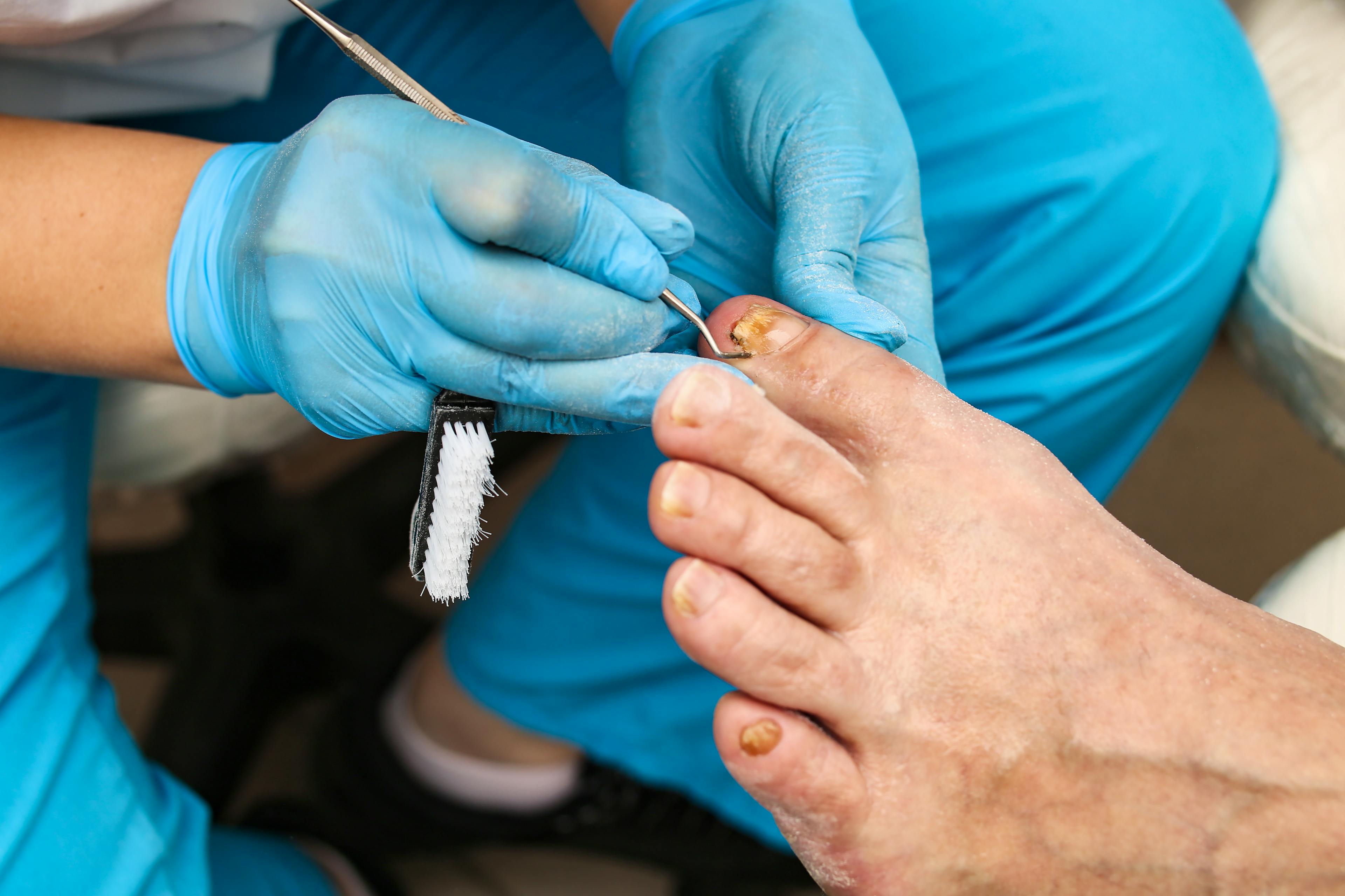 Doctor working on patient with ingrown toenail