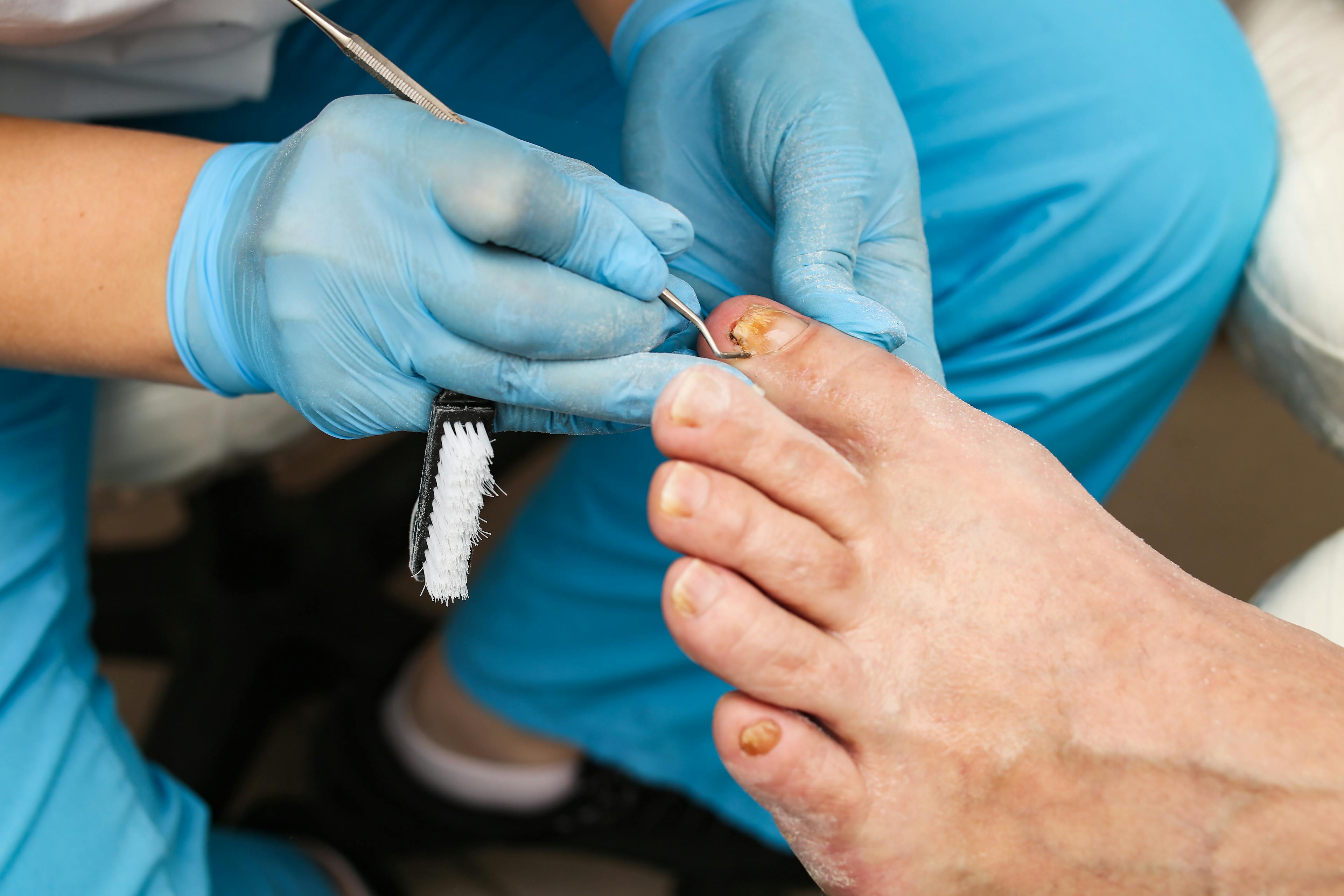 Doctor working on patient with ingrown toenail