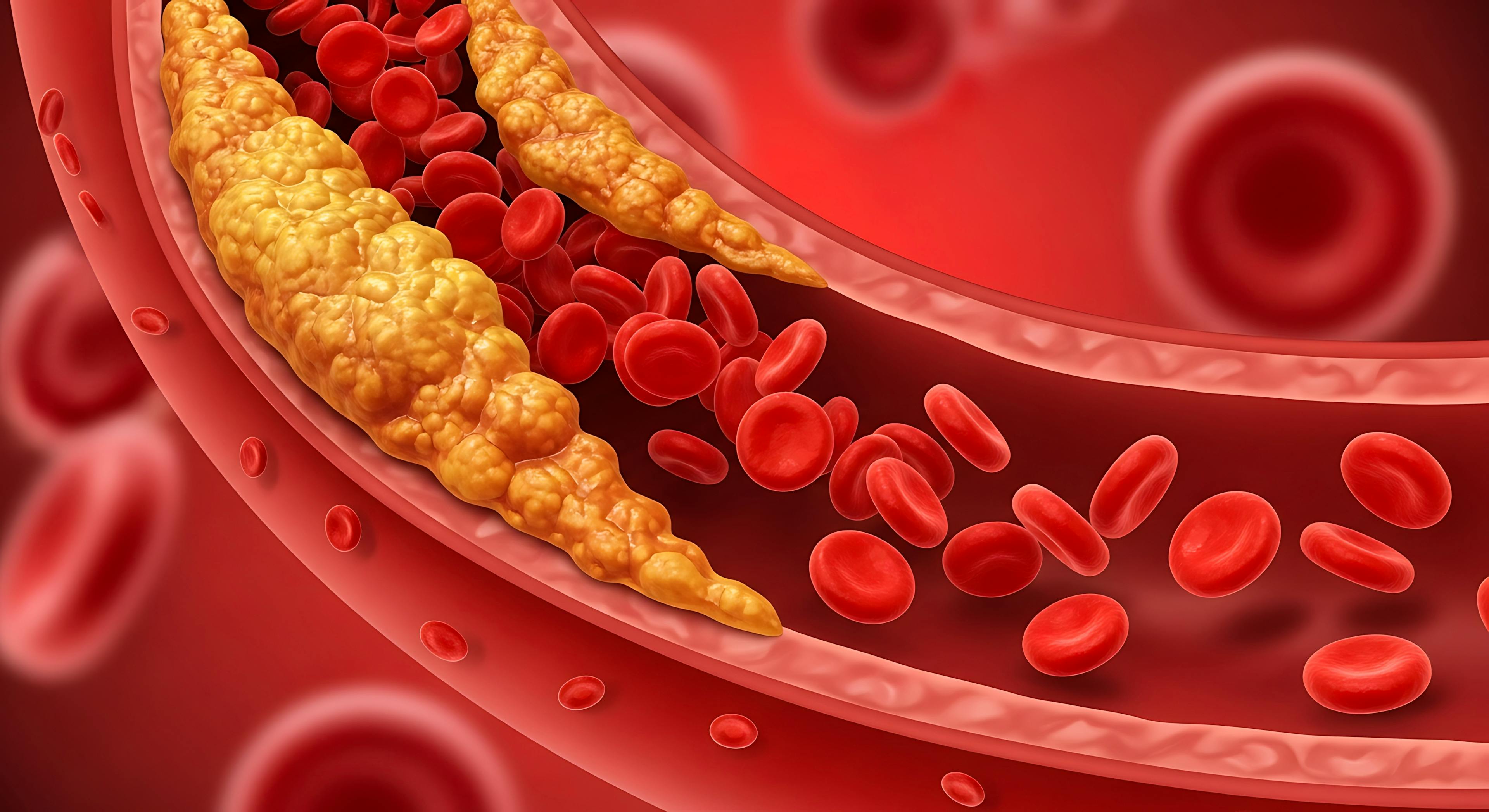Diagram showing blood clot within artery