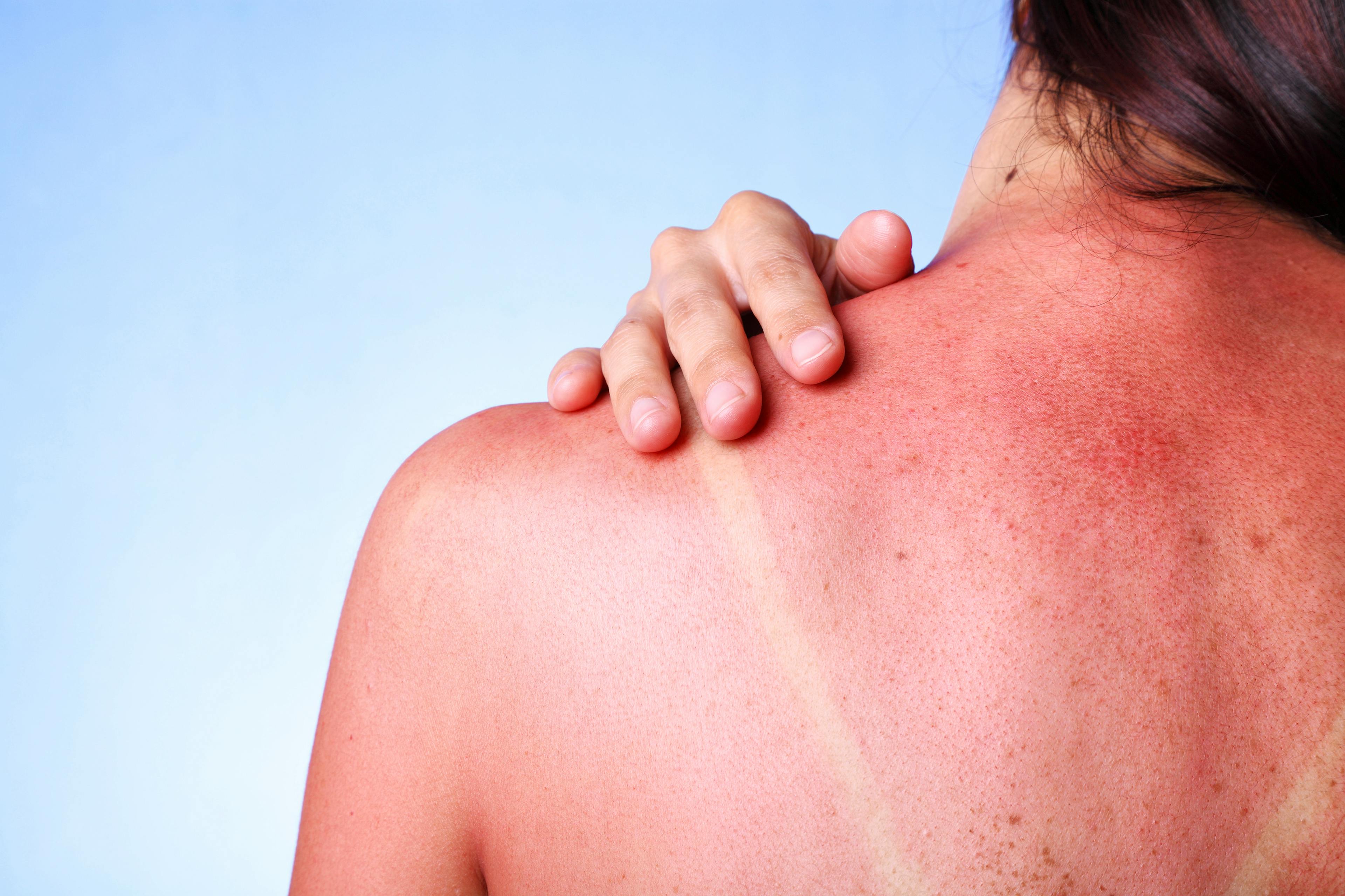Woman with sunburn on her back
