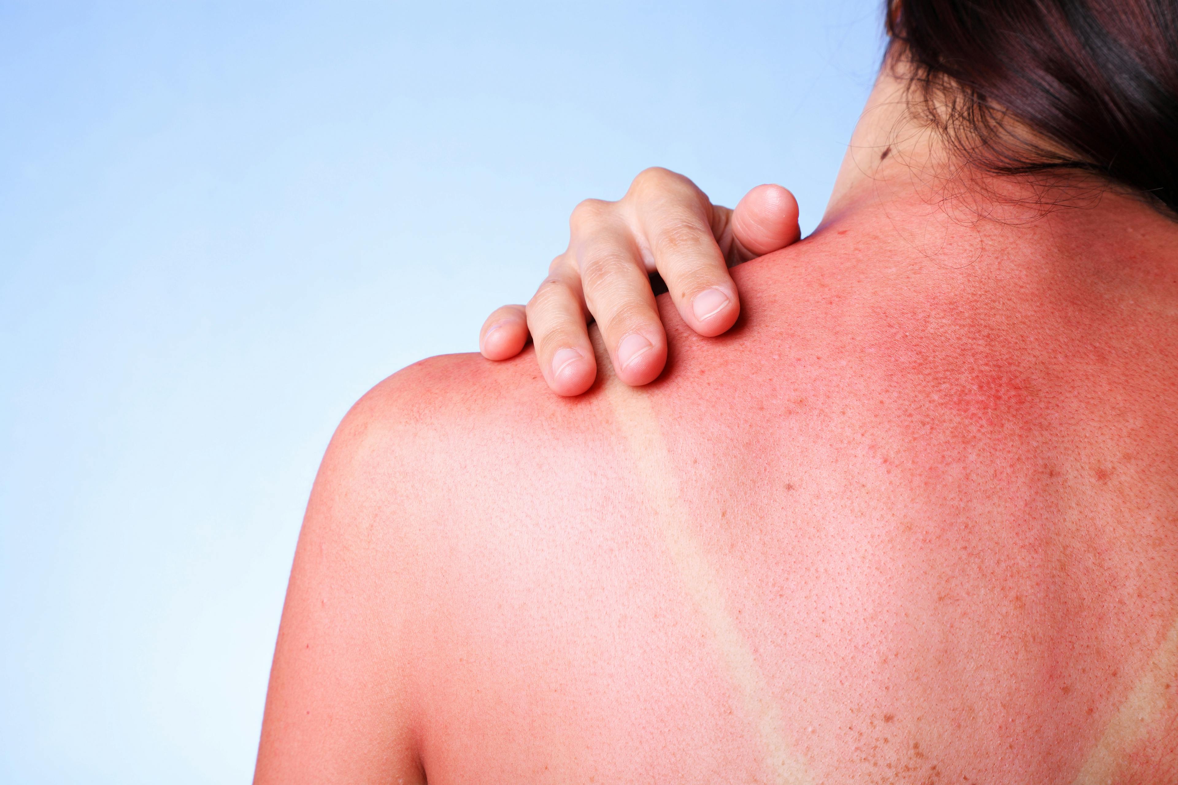 Woman with sunburn on her back