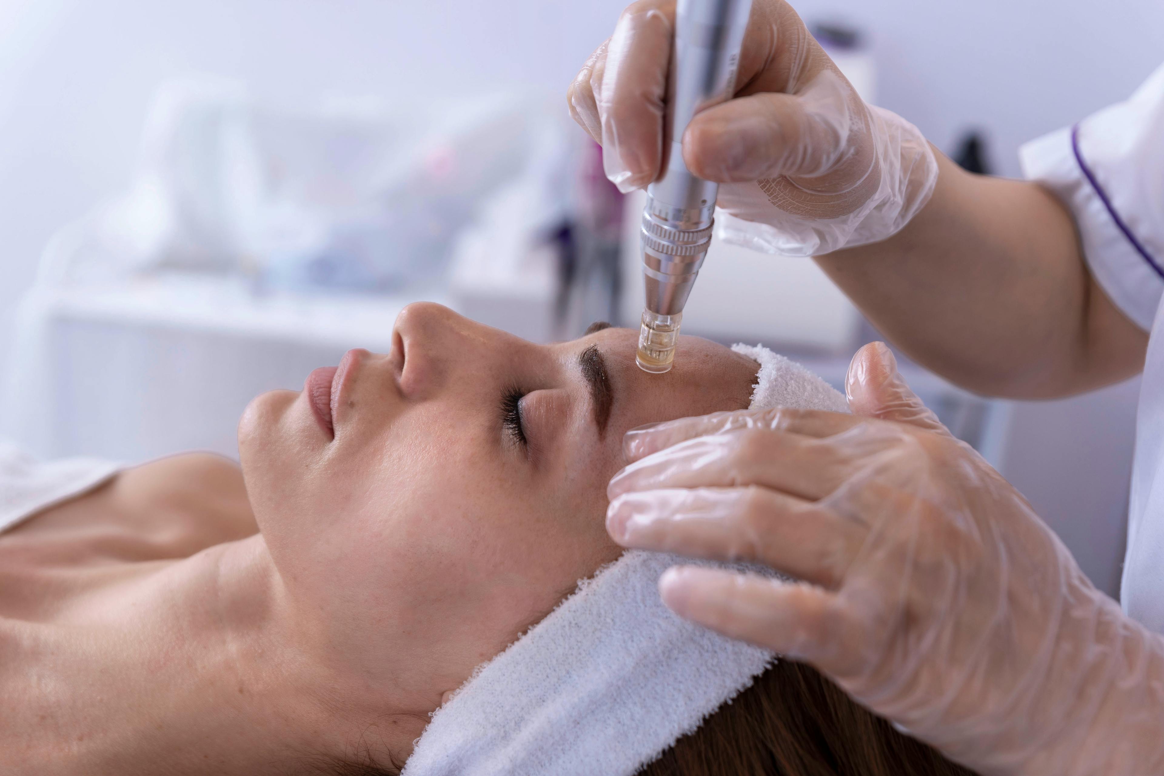 Woman undergoing a microneedling process