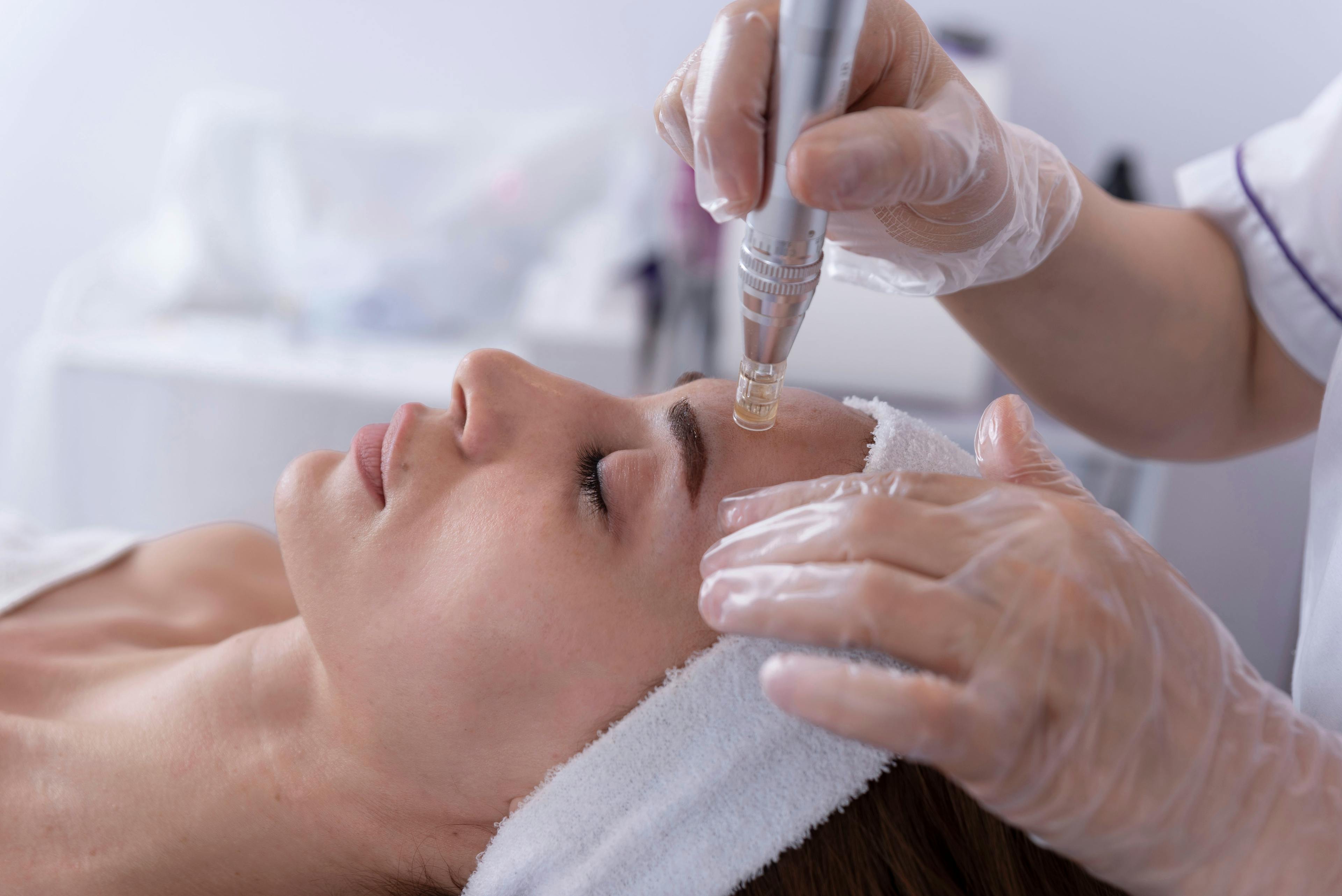Woman undergoing a microneedling process