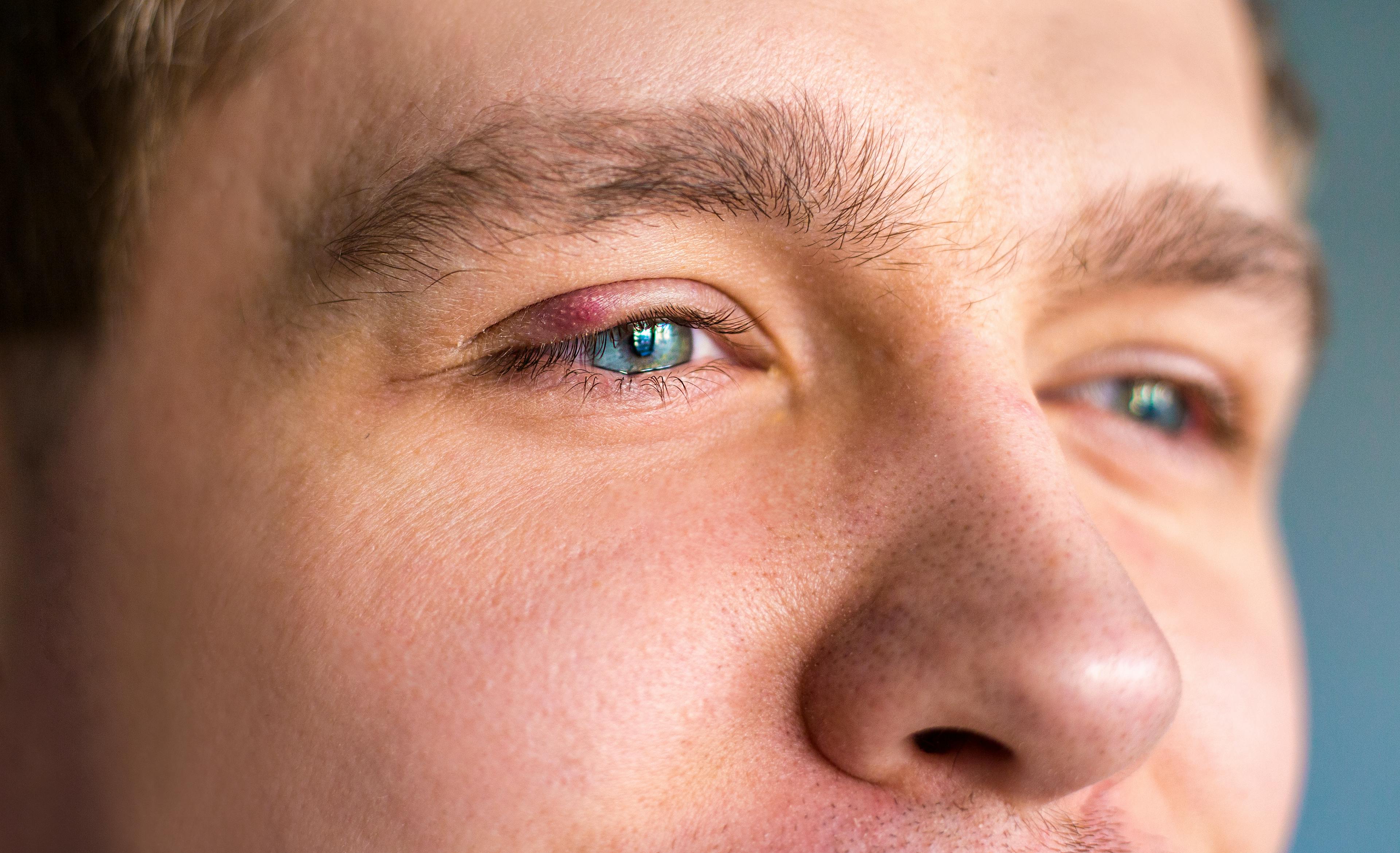 Man with Blepharitis on his right eye