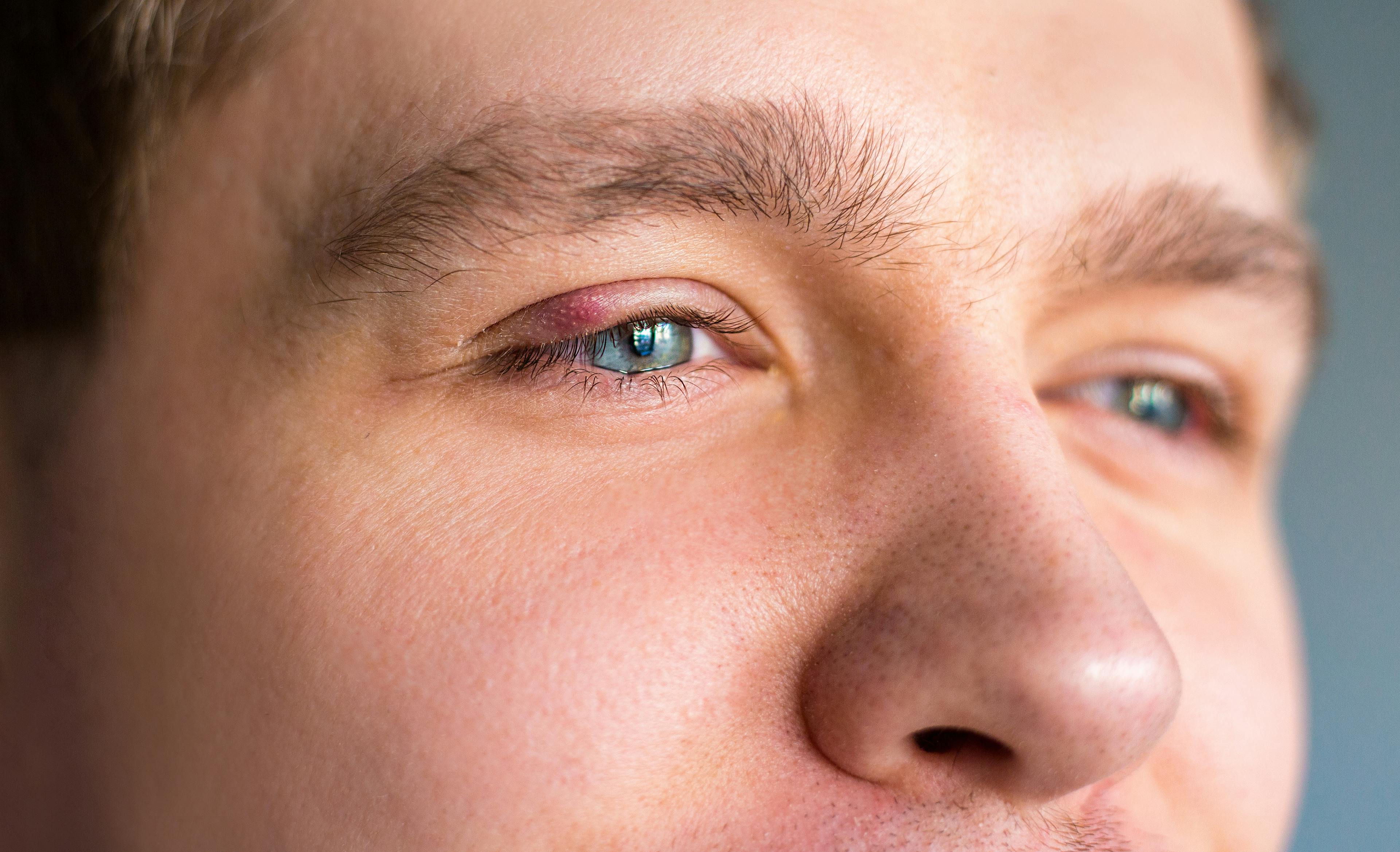Man with Blepharitis on his right eye