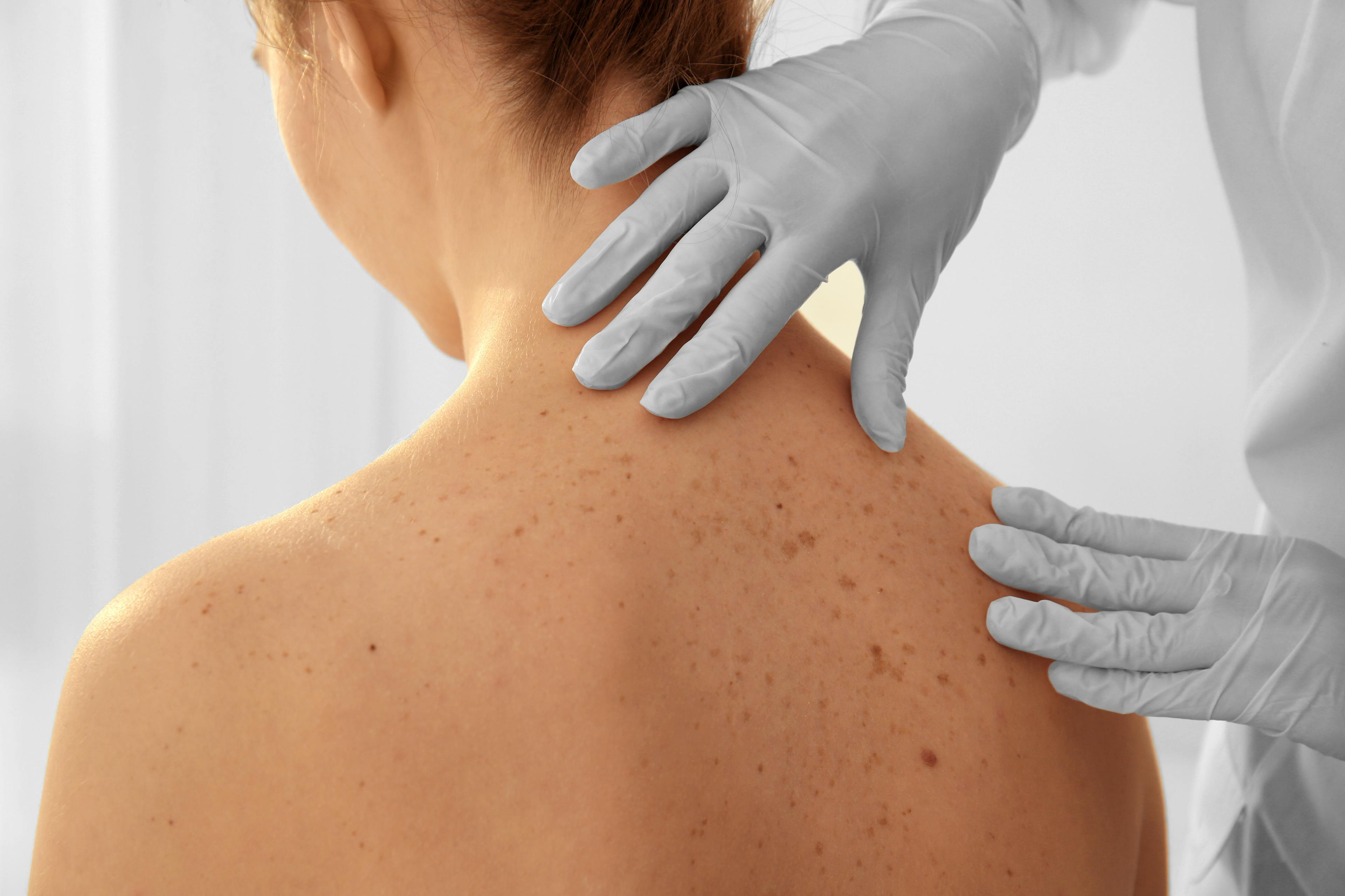 Dermatologist inspects woman's back to see if there are any precancerous lesions