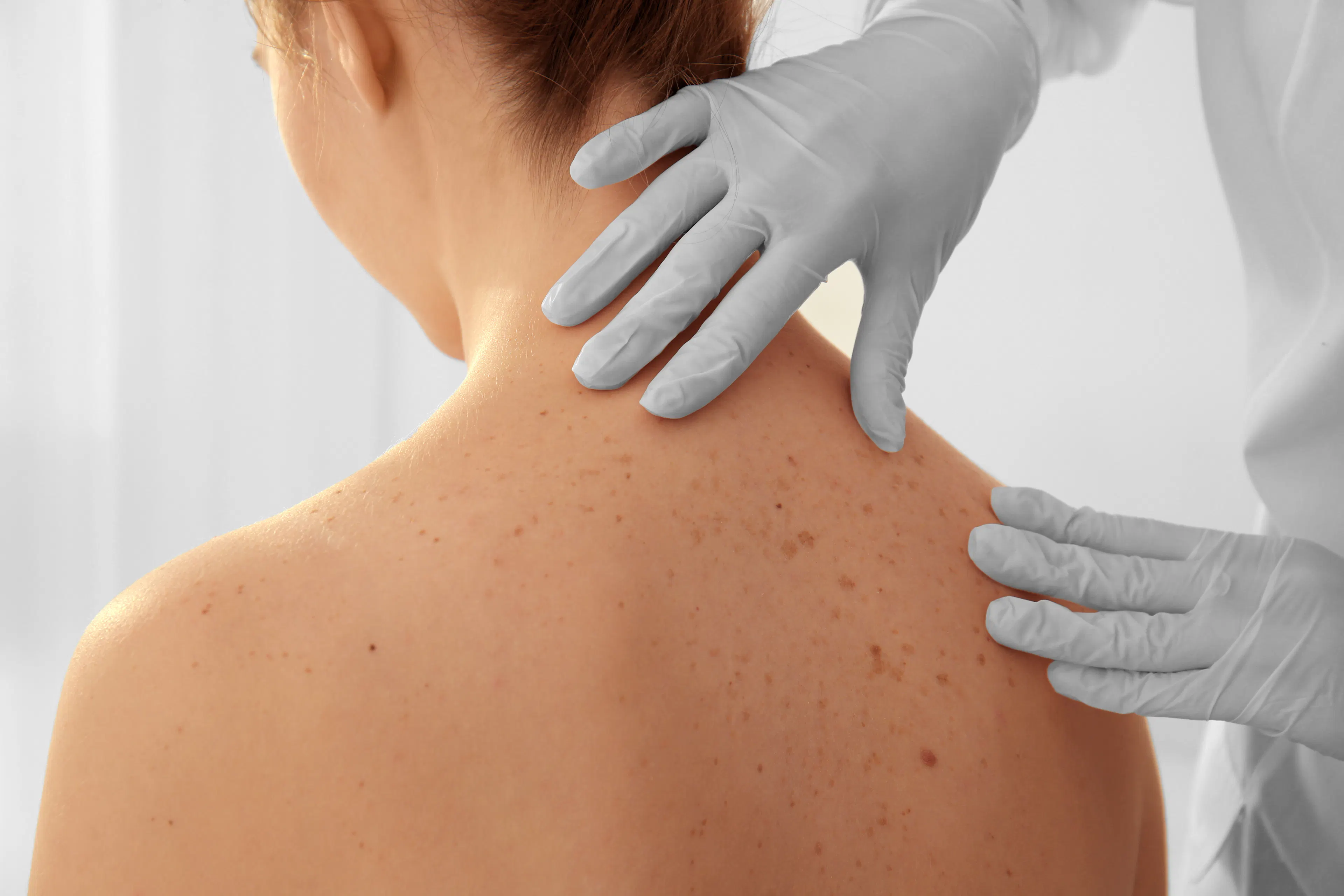 Dermatologist inspects woman's back to see if there are any precancerous lesions