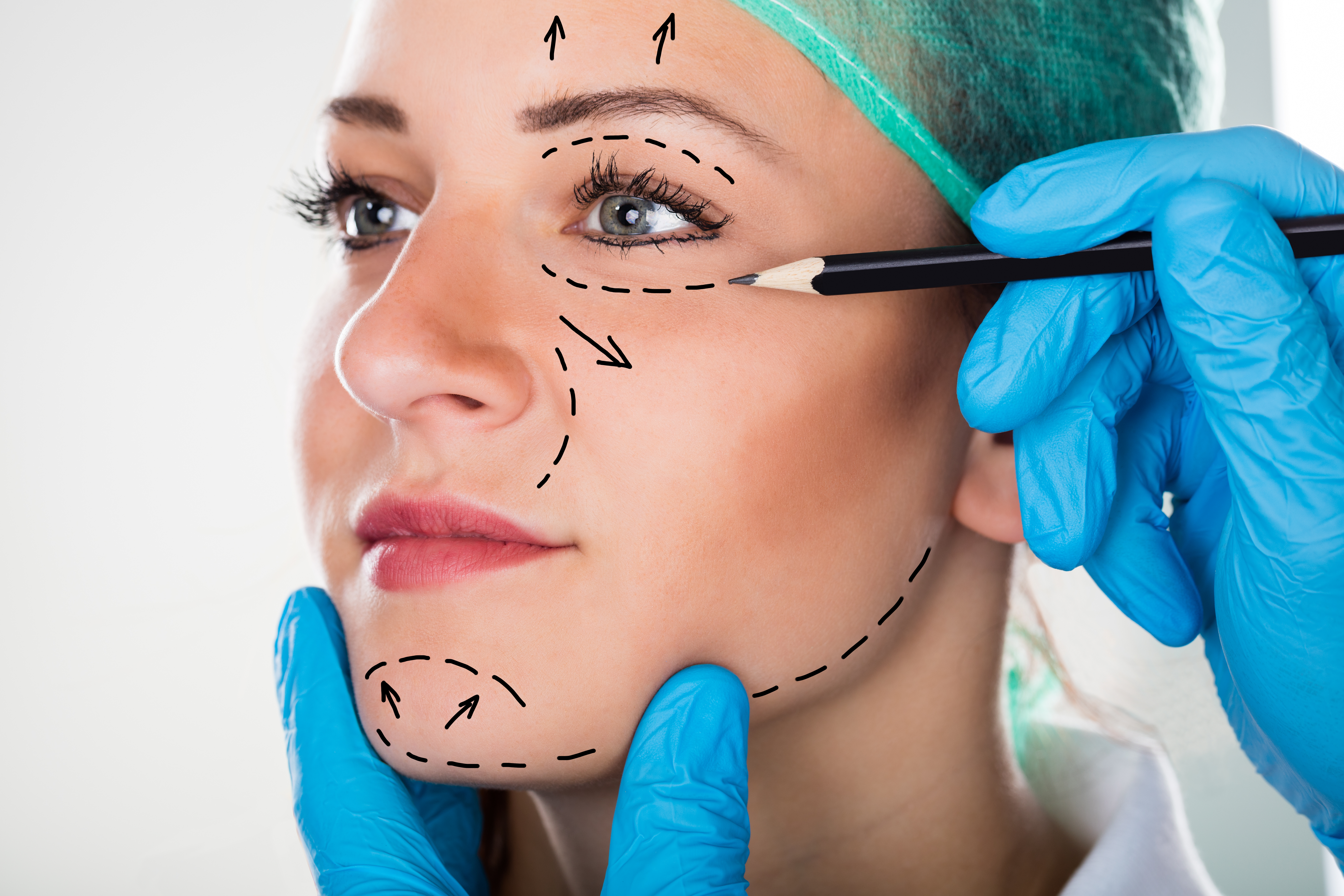 Woman getting prepped with facial drawings by a doctor for plastic surgery 