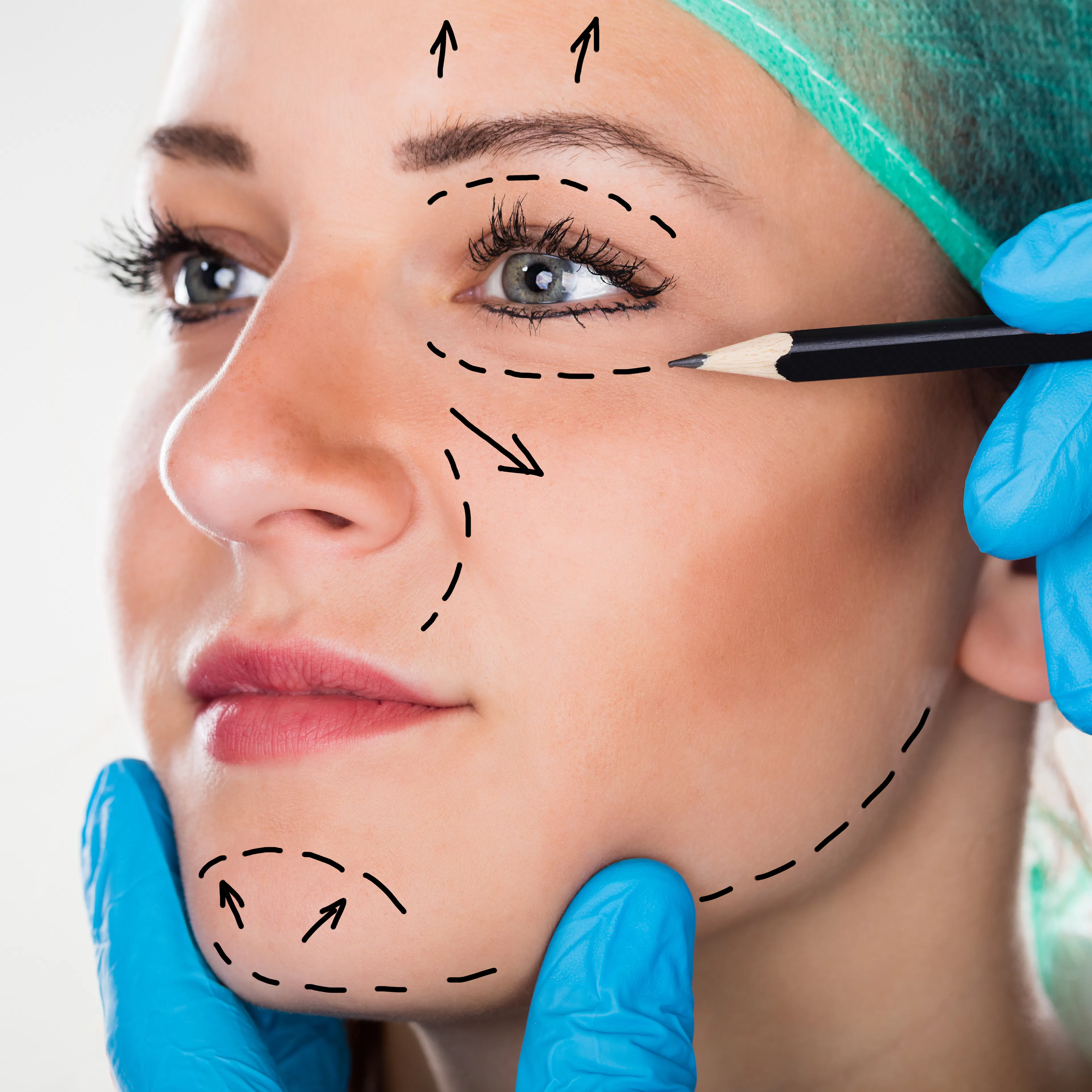 Woman getting prepped with facial drawings by a doctor for plastic surgery 