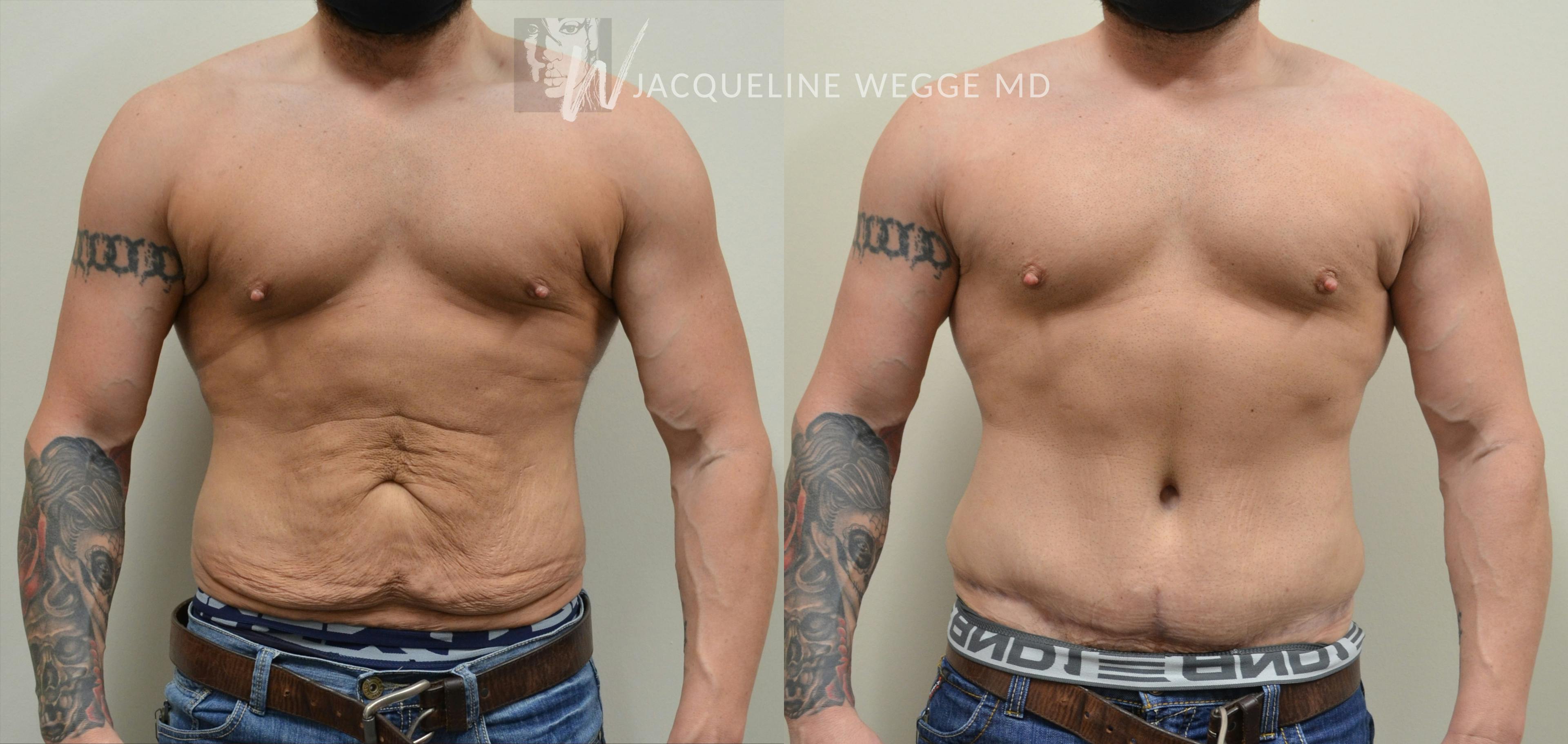 A patient of Dr. Jacqueline Wegge's, CLS Health plastic surgeon, after skin removal surgery following dramatic weight loss.