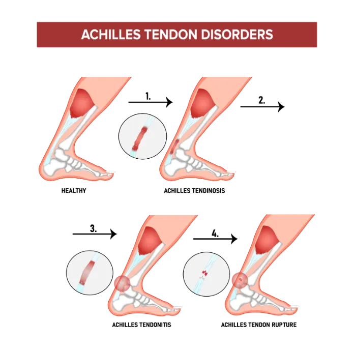 A graphic showing the different Achilles tendon disorders.