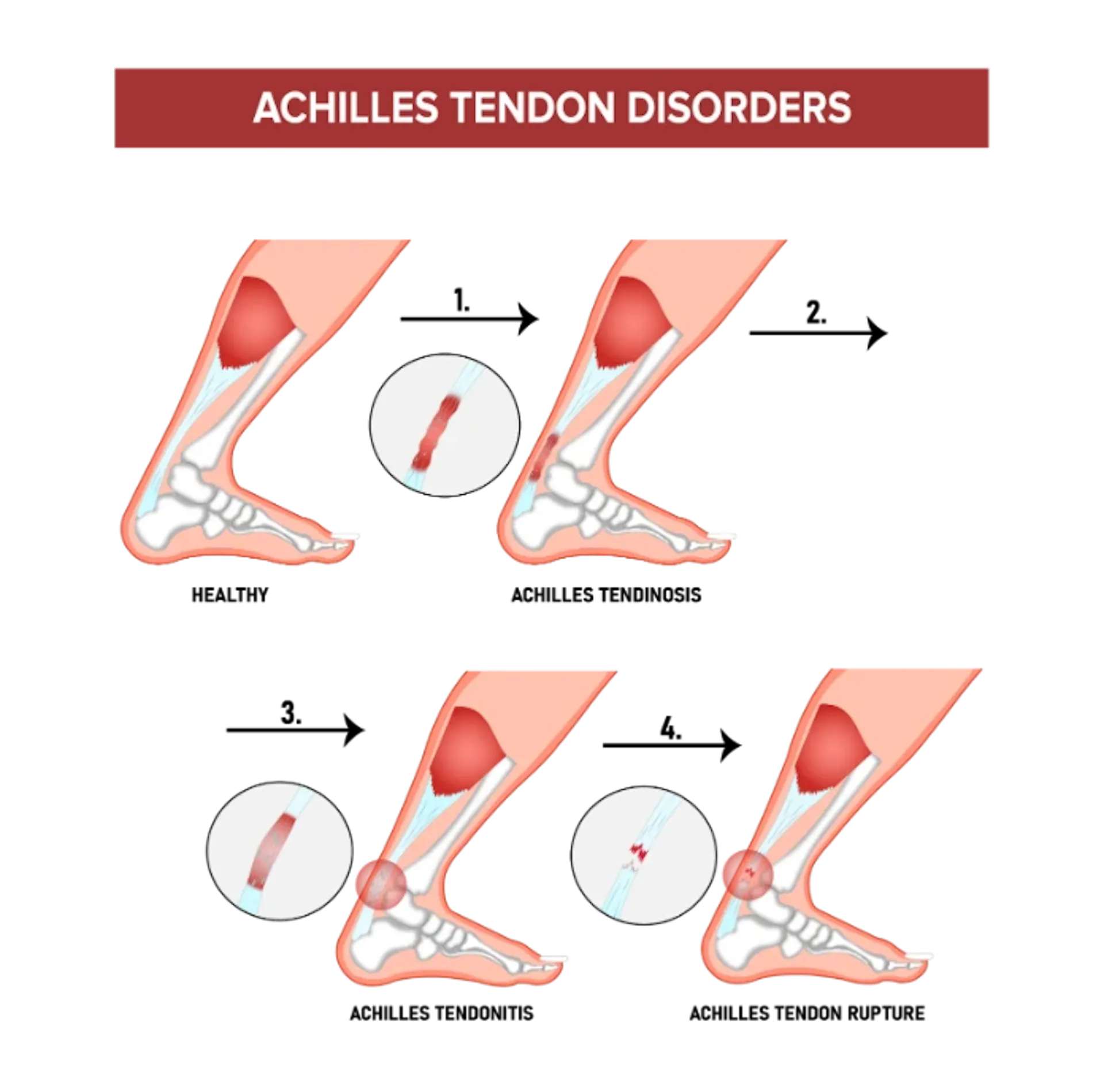 A graphic showing the different Achilles tendon disorders.