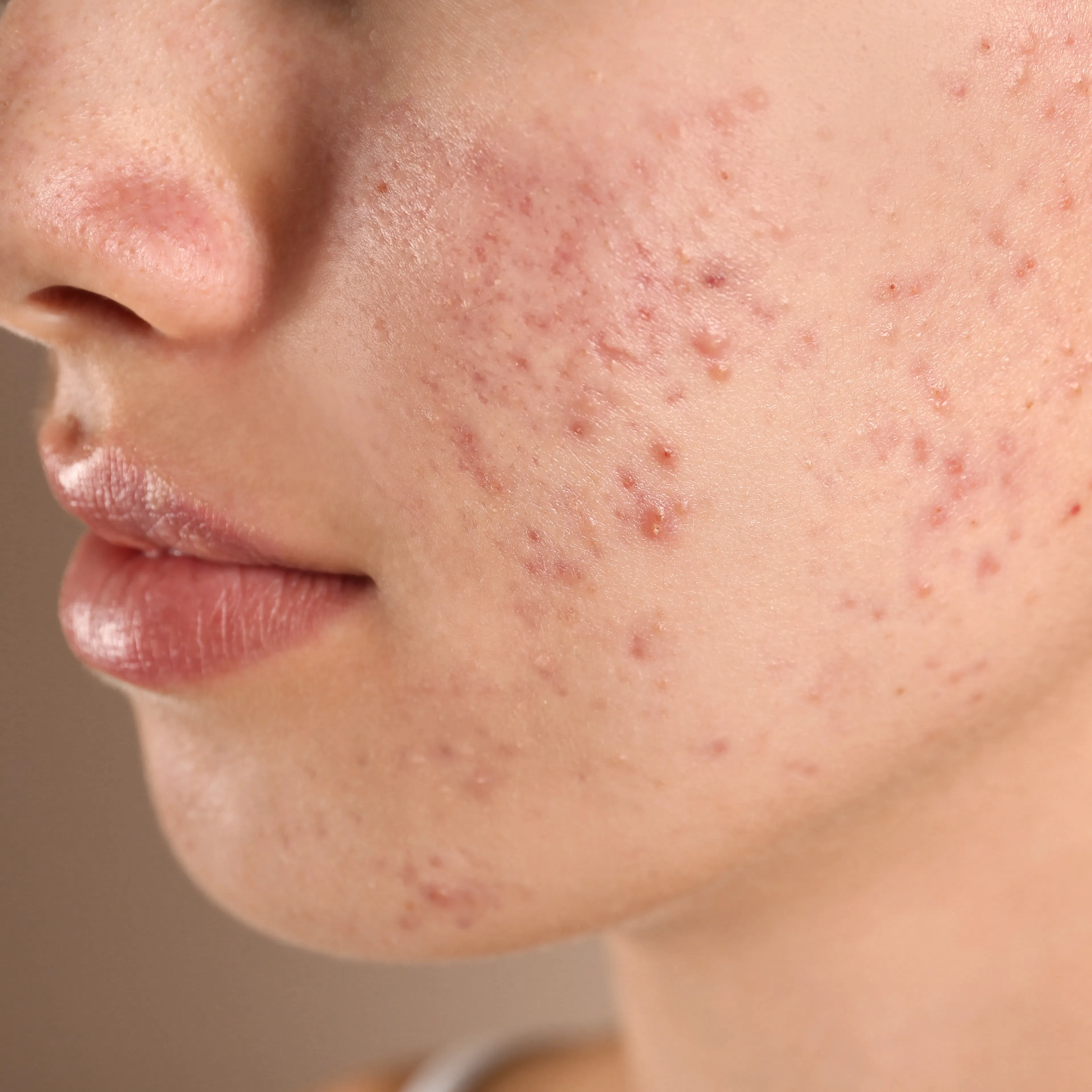 A close-up of a woman's side profile with acne.