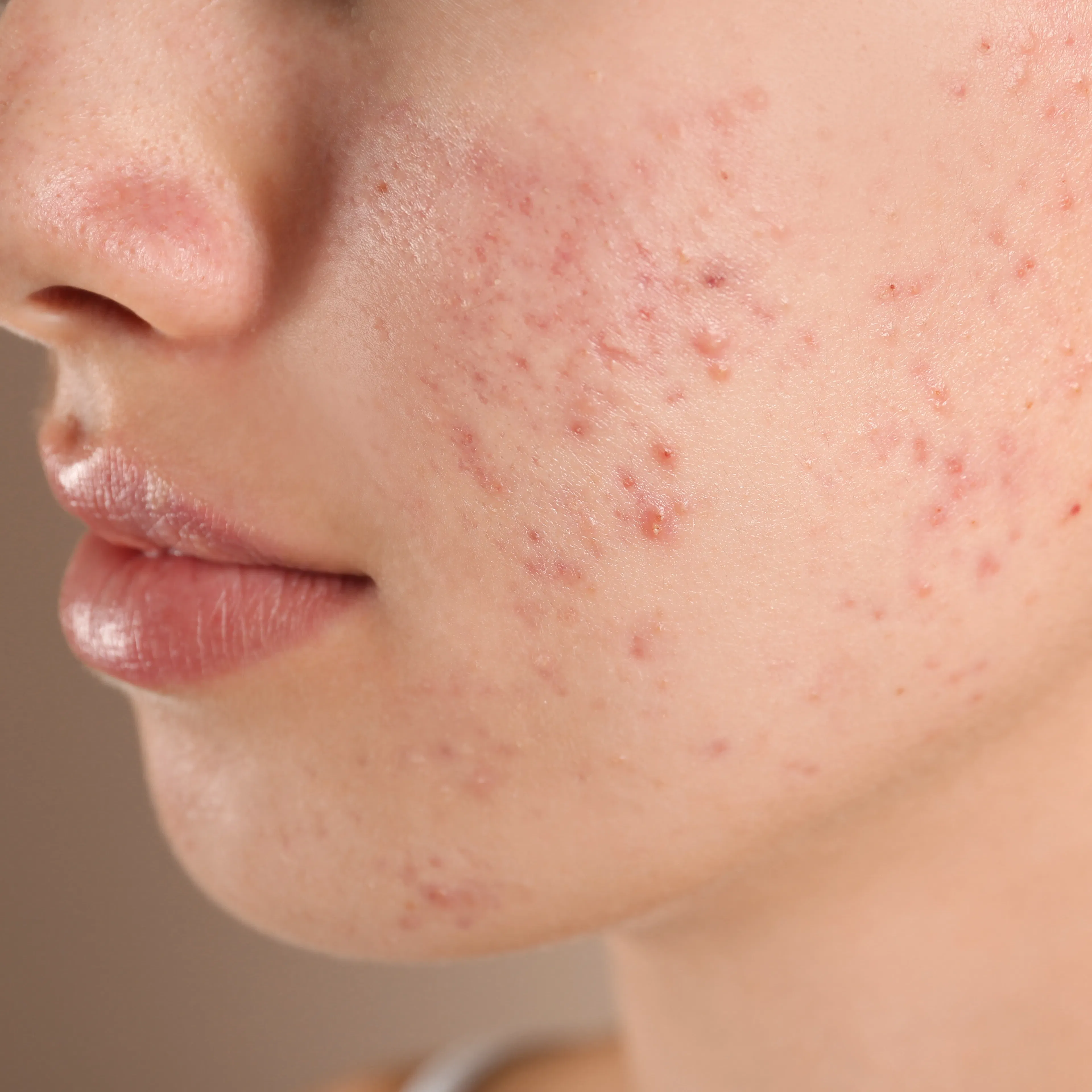 A close-up of a woman's side profile with acne. 