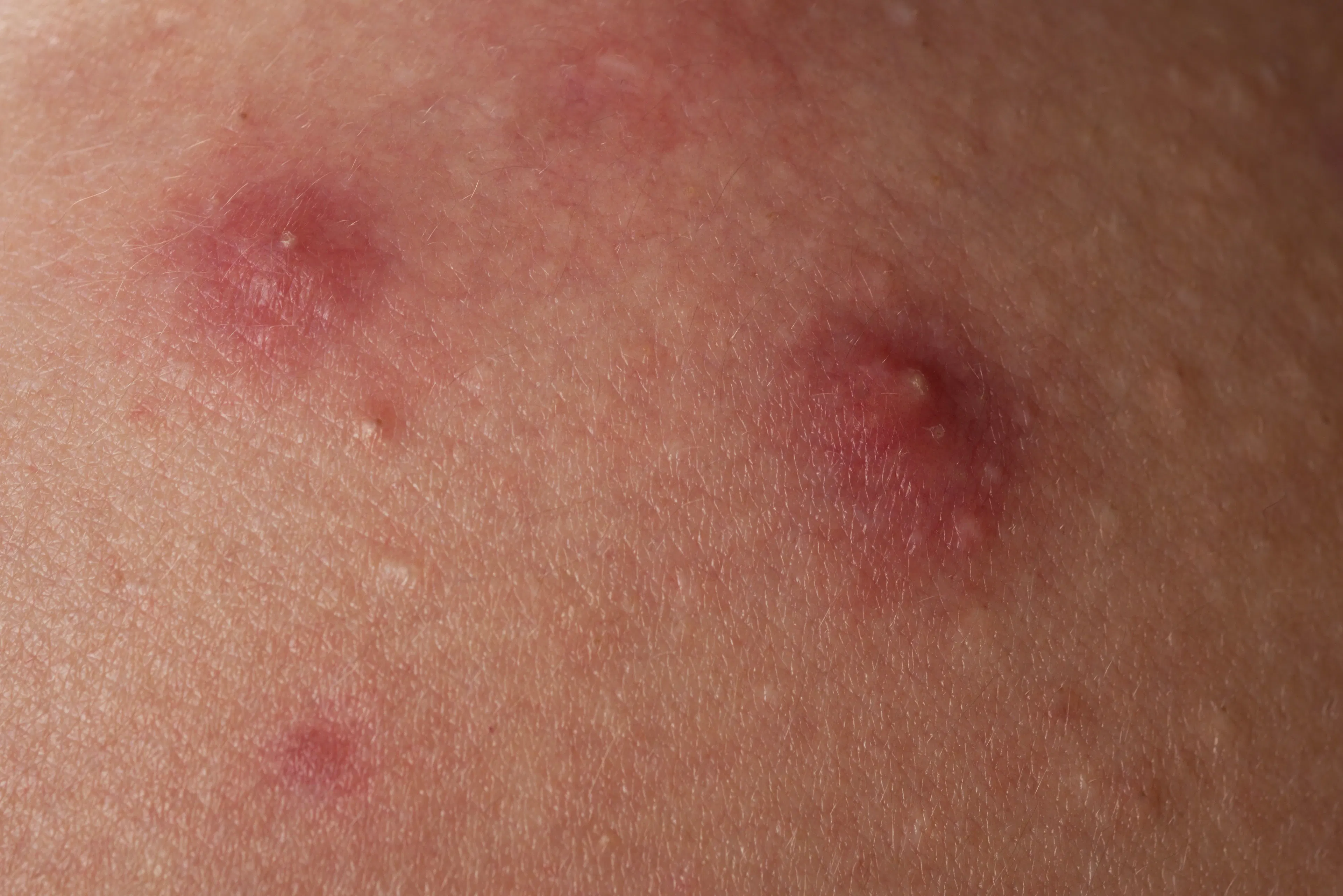 A close-up of inflammatory acne, showing raised red bumps, papules, and pustules.