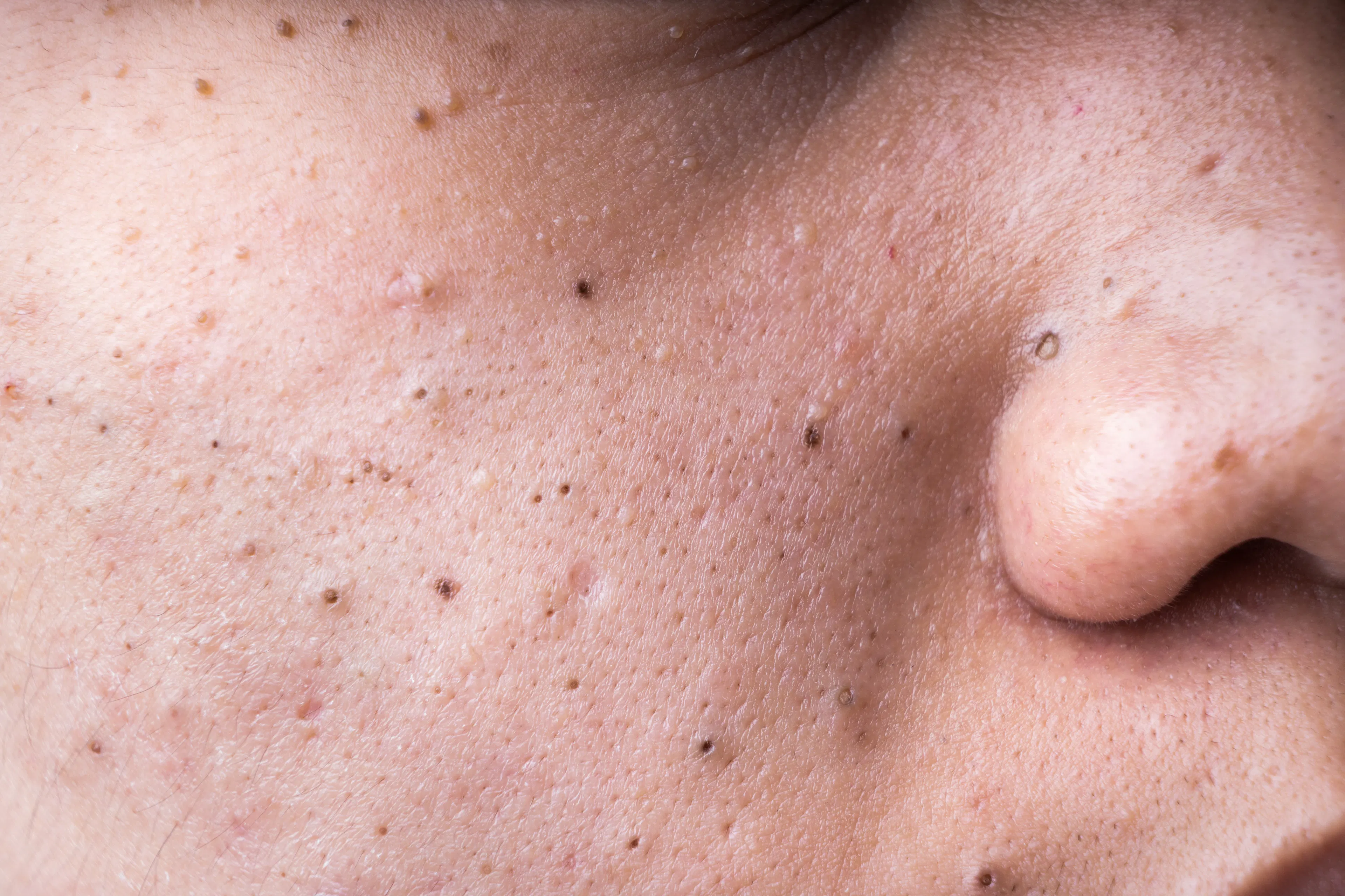 A close-up of a person's face showing blackheads and whiteheads (comedonal acne).