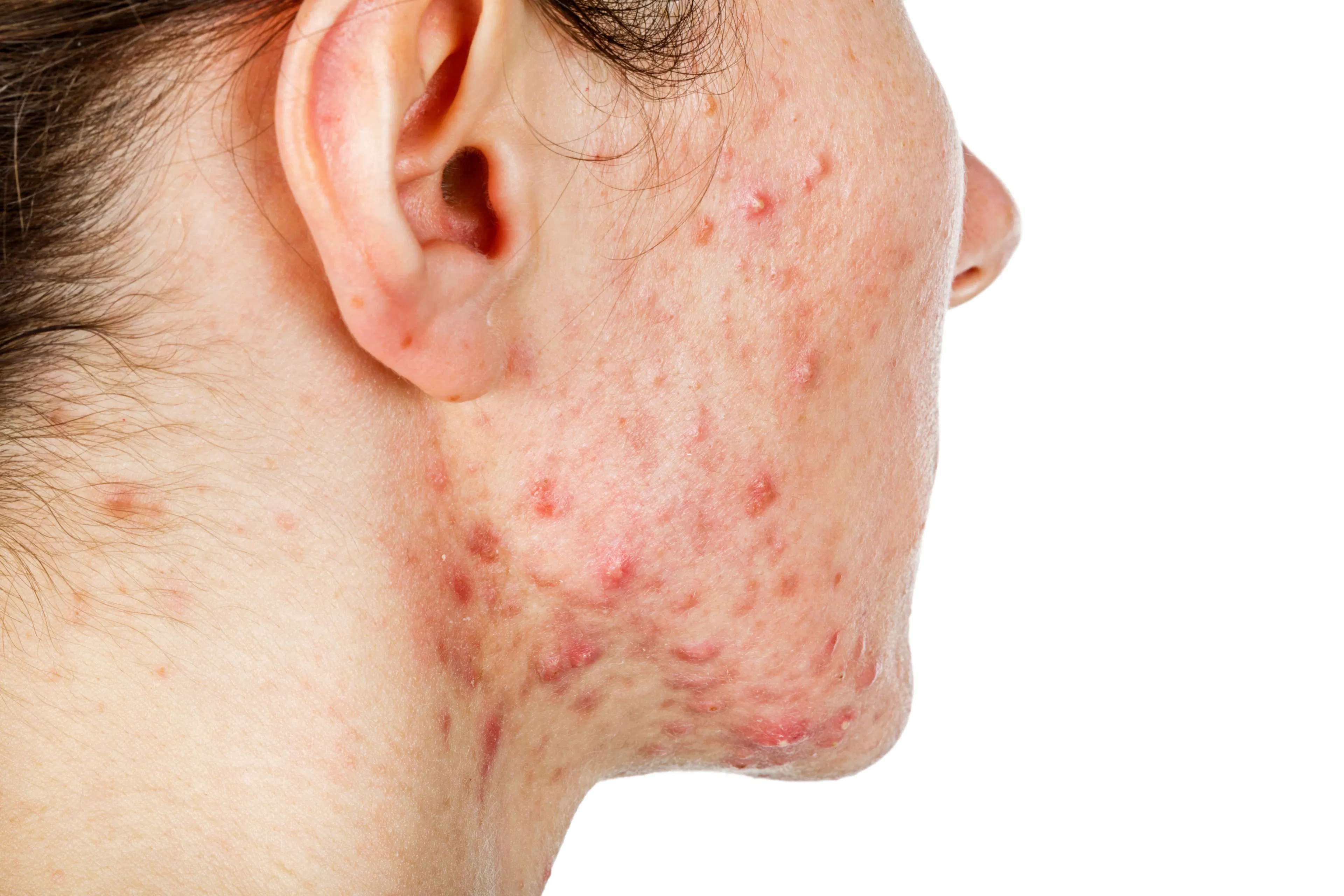 A close-up of a woman with cystic acne.