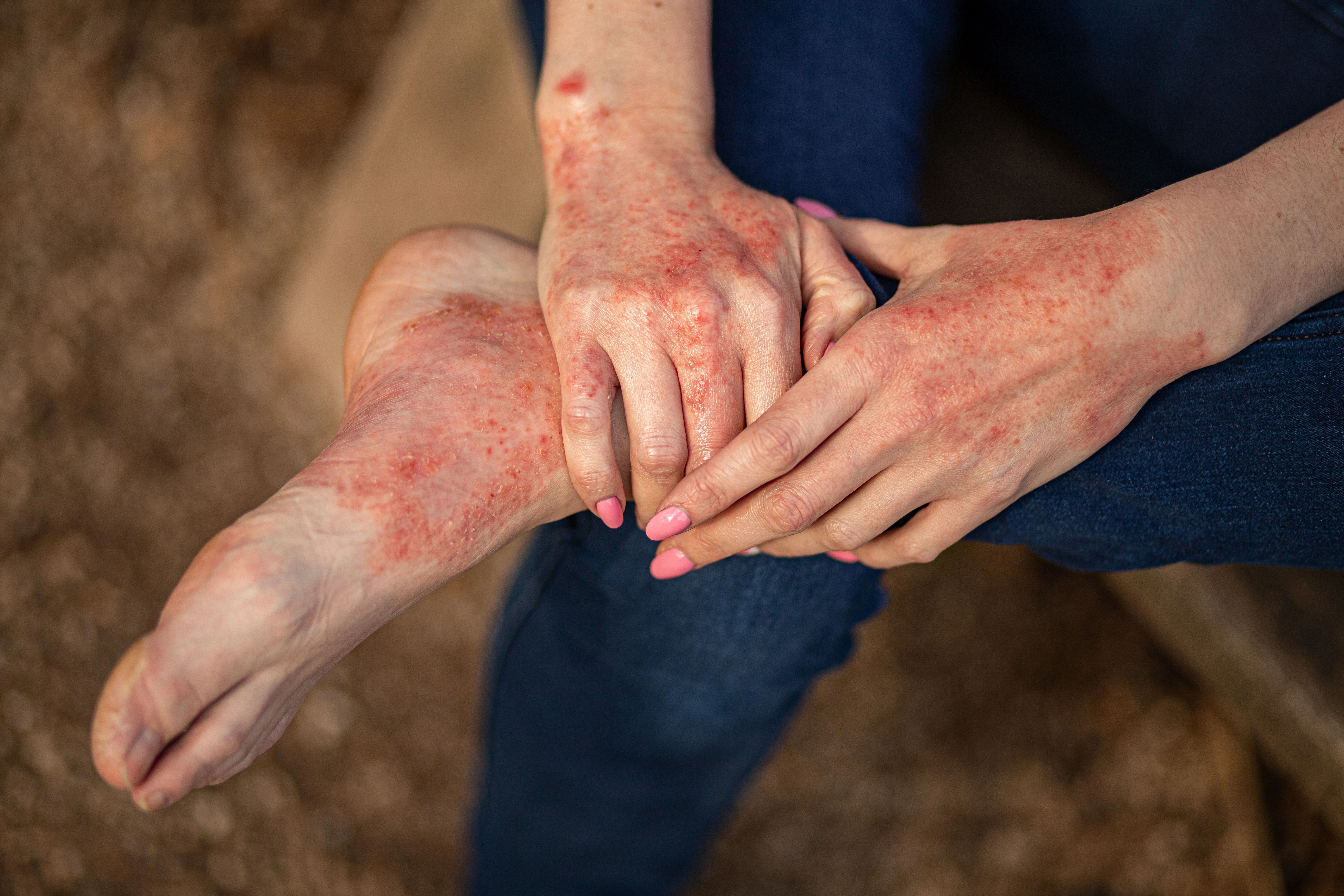 A person with eczema's foot and hands are shown.