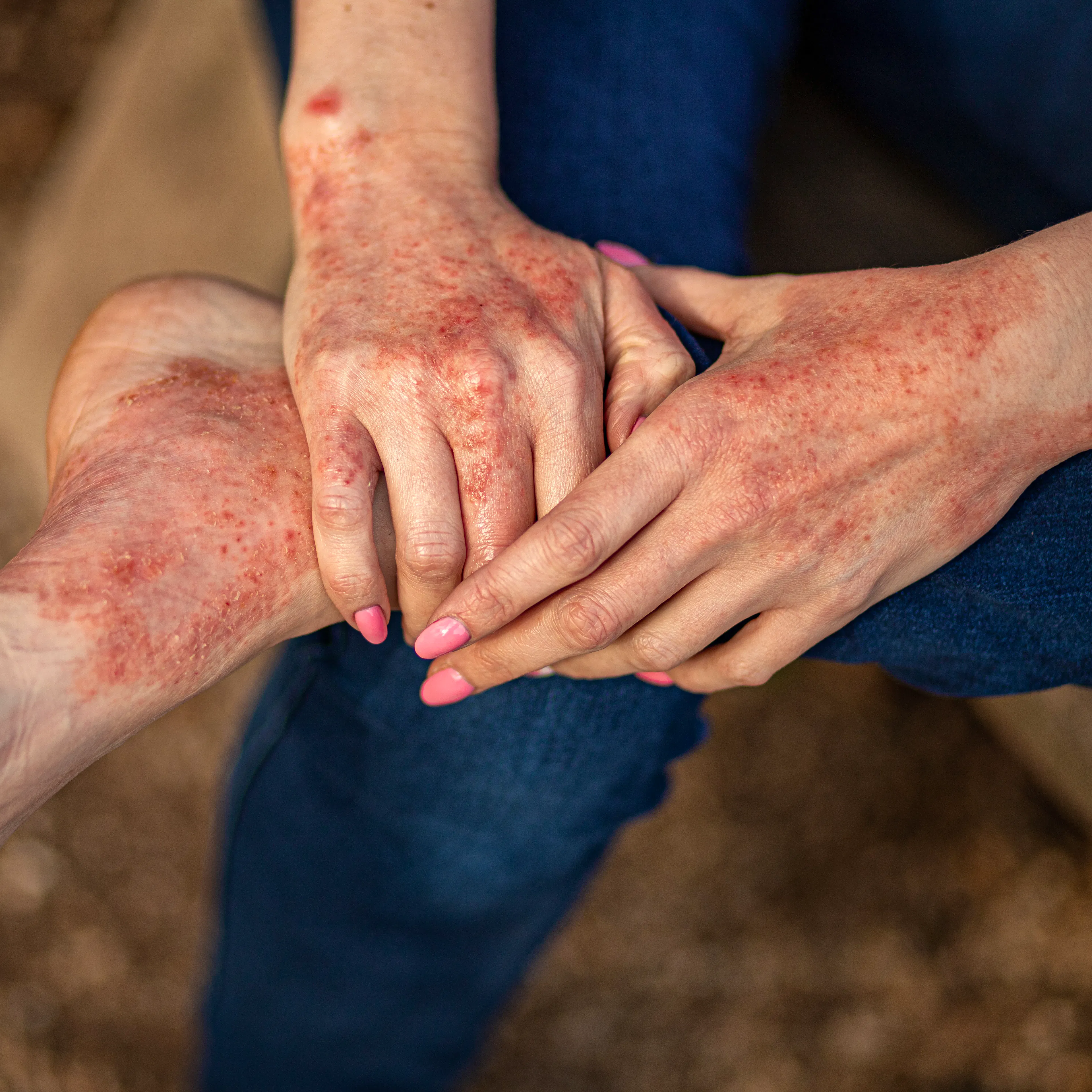 A person with eczema's foot and hands are shown.
